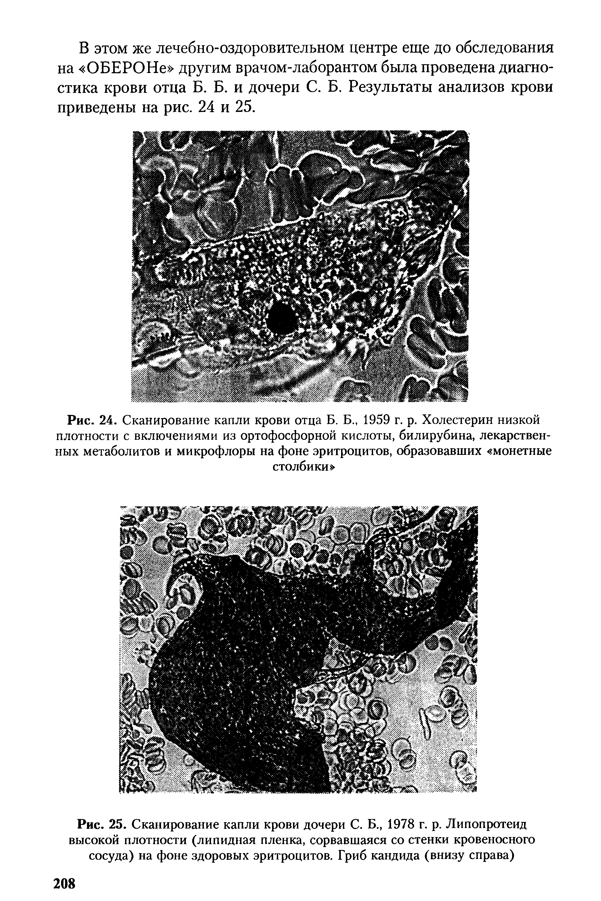 Рис. 24. Сканирование капли крови отца Б. Б., 1959 г. р. Холестерин низкой плотности с включениями из ортофосфорной кислоты, билирубина, лекарственных метаболитов и микрофлоры на фоне эритроцитов, образовавших монетные столбики ...