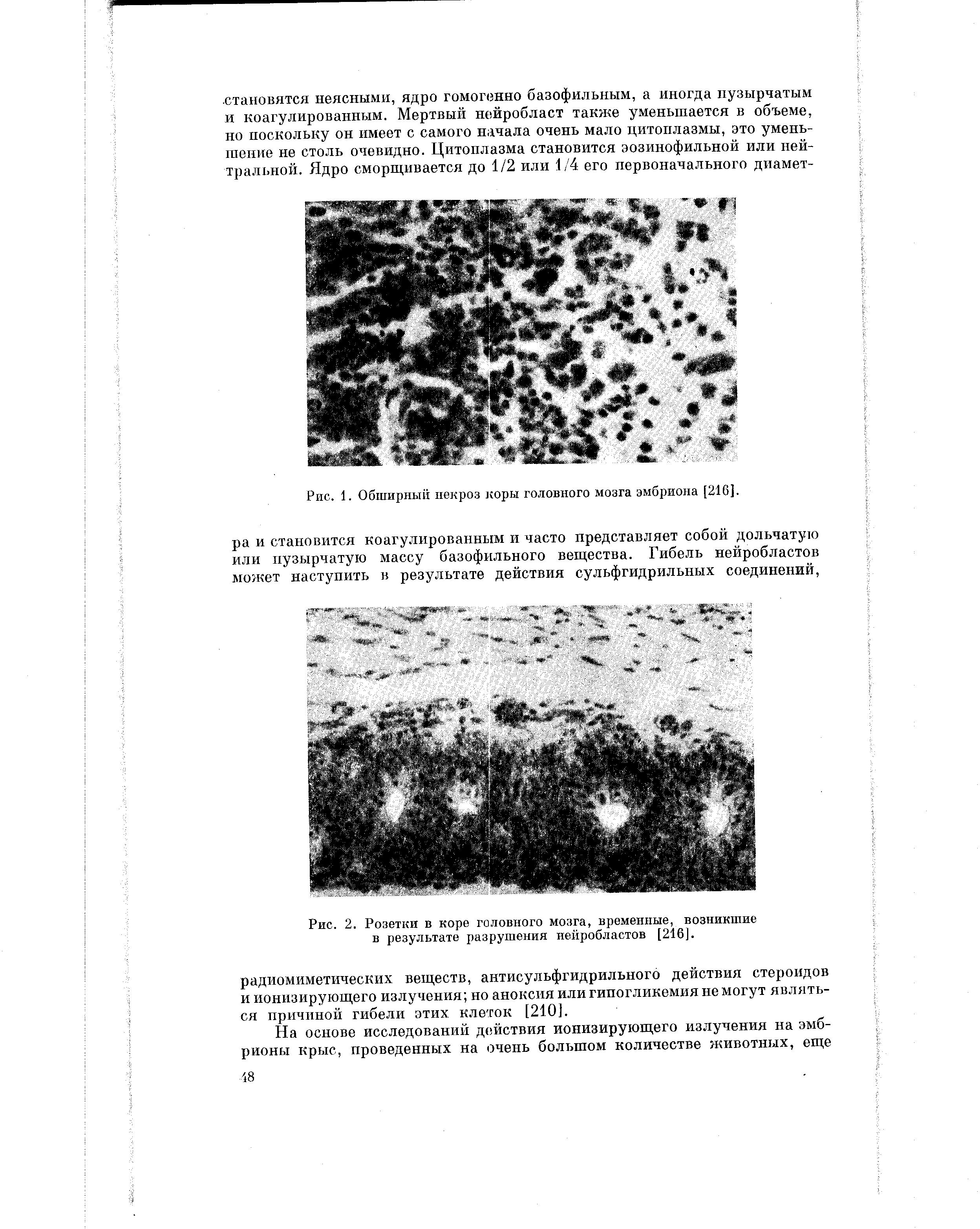 Рис. 2. Розетки в коре головного мозга, временные, возникшие в результате разрушения нейробластов [216].