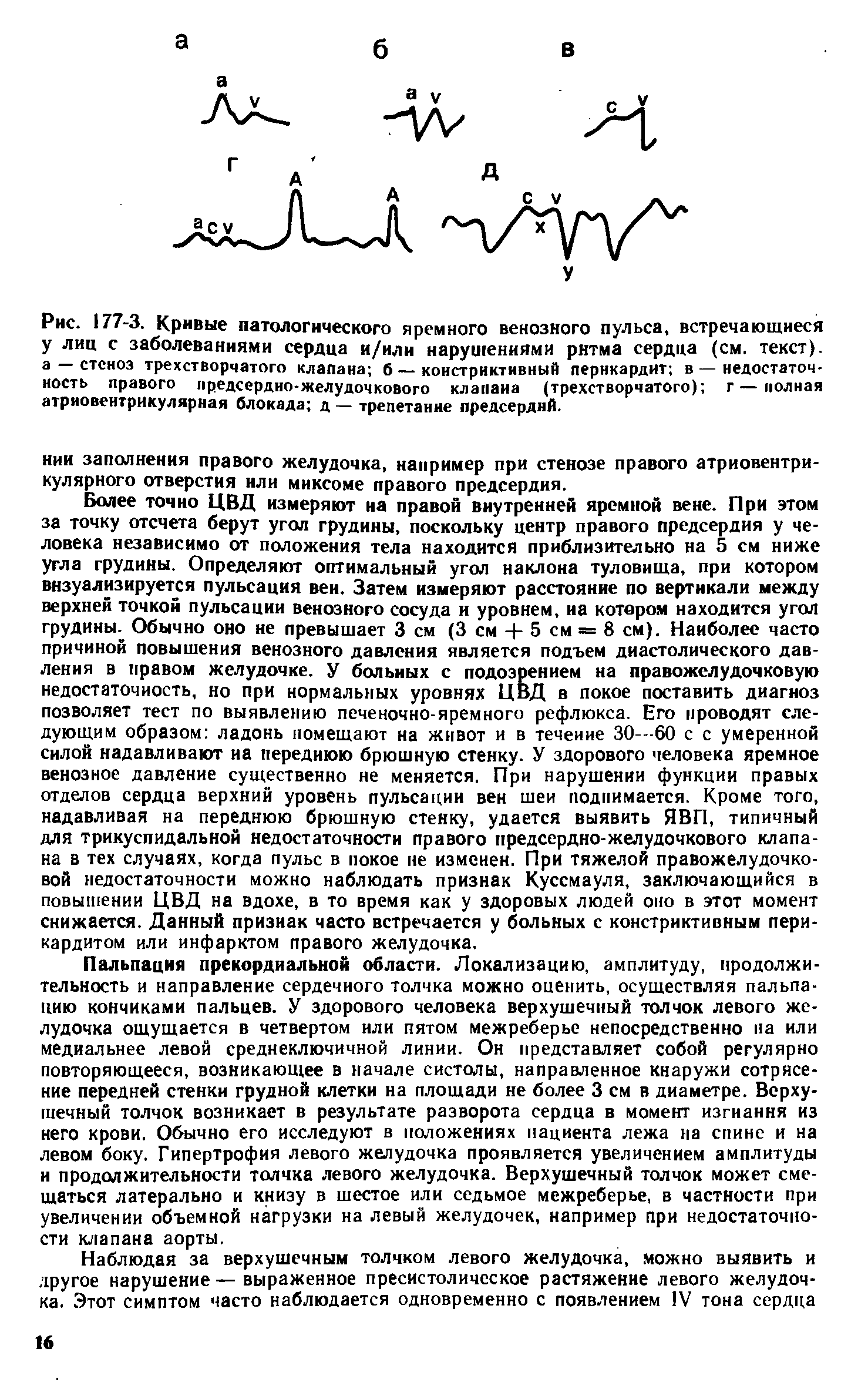 Рис. 177-3. Кривые патологического яремного венозного пульса, встречающиеся у лиц с заболеваниями сердца и/или нарушениями ритма сердца (см. текст), а — стеноз трехстворчатого клапана б—констриктивный перикардит в — недостаточность правого предсердно-желудочкового клапана (трехстворчатого) г — полная атриовентрикулярная блокада д — трепетание предсердий.