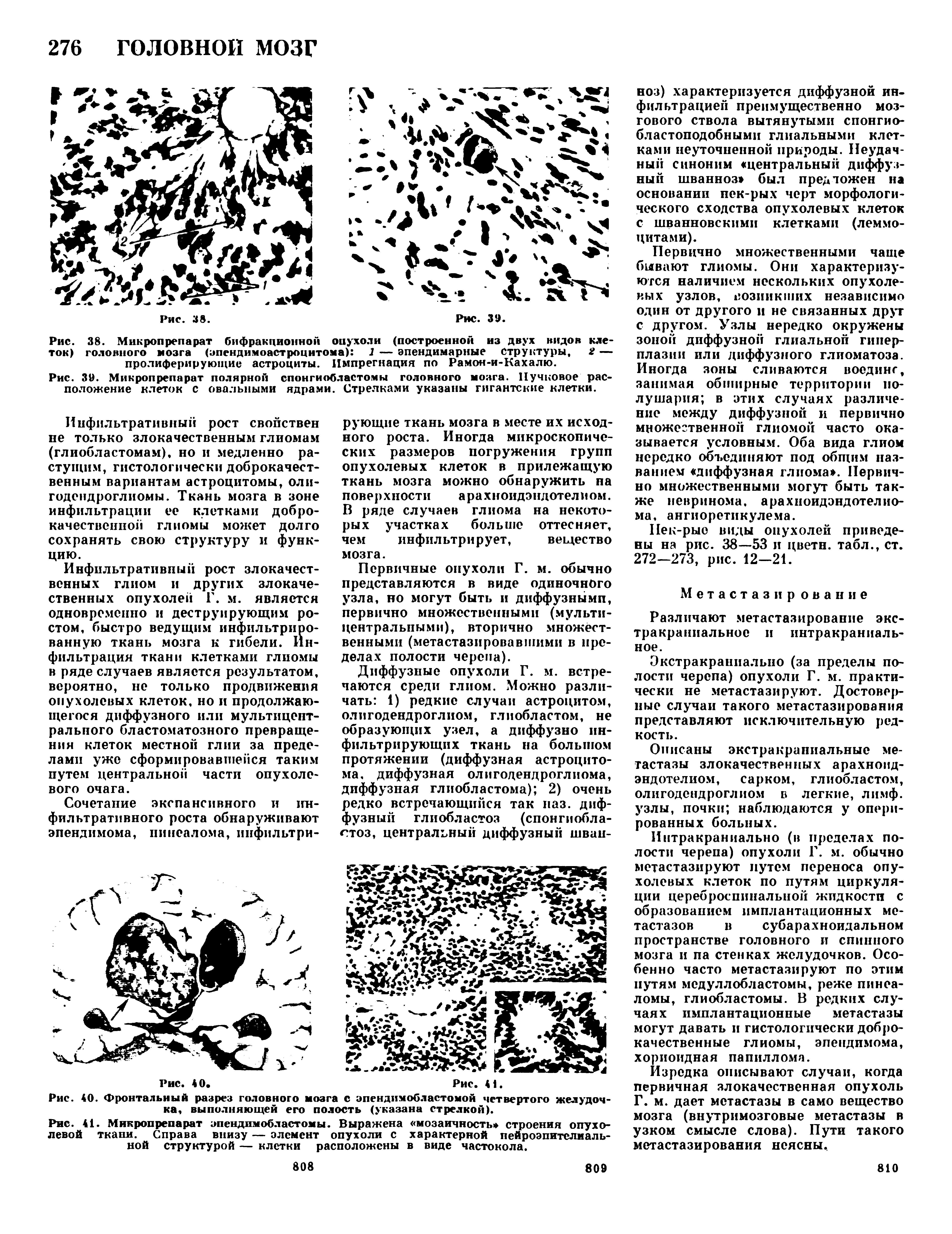 Рис. 41. Мнкропрепарат эпендимобластомы. Выражена мозаичность строения опухолевой ткани. Справа внизу — элемент опухоли с характерной нейроэпителиальной структурой — клетки расположены в виде частокола.