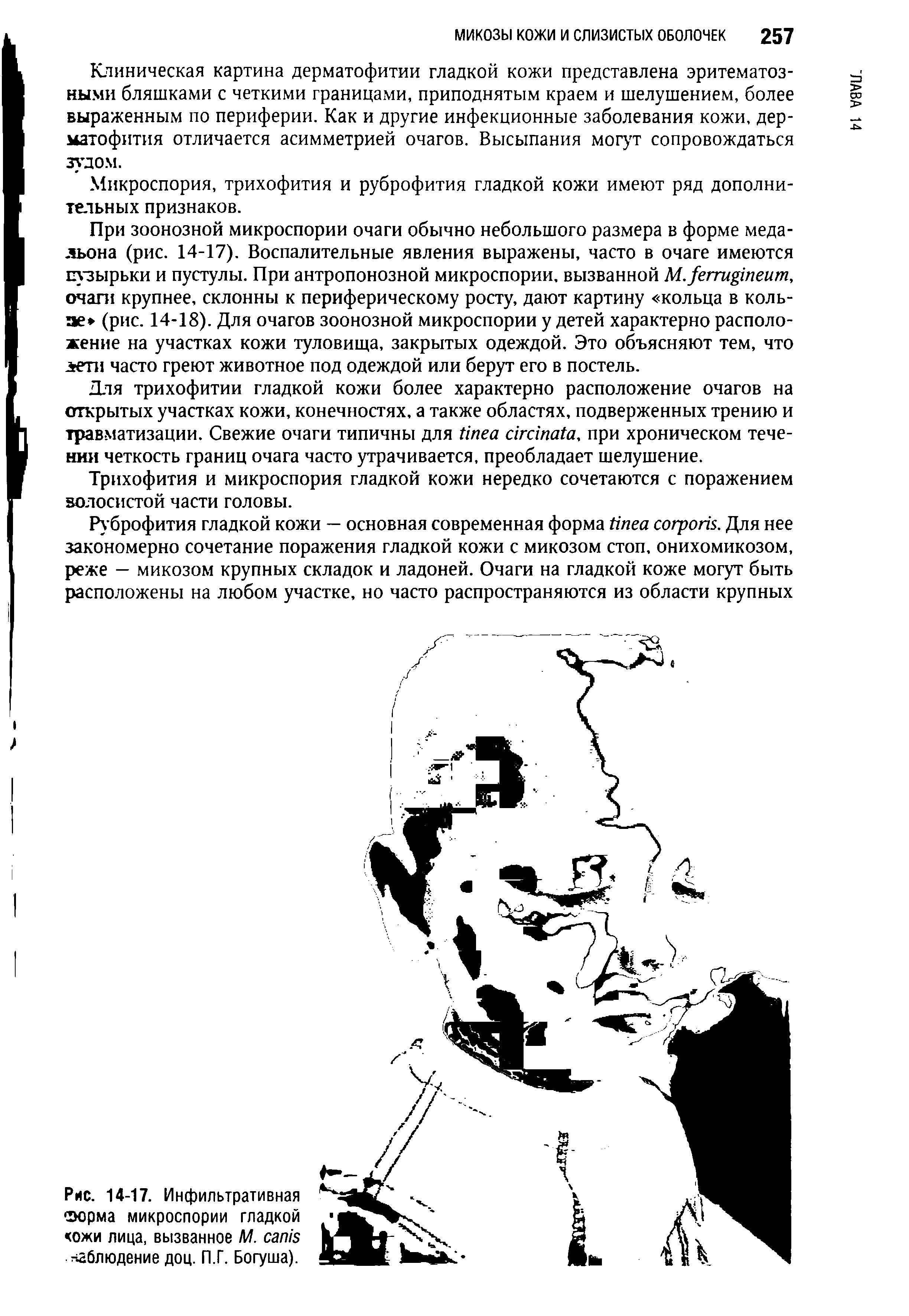 Рис. 14-17. Инфильтративная Форма микроспории гладкой кожи лица, вызванное М. наблюдение доц. П.Г. Богуша).