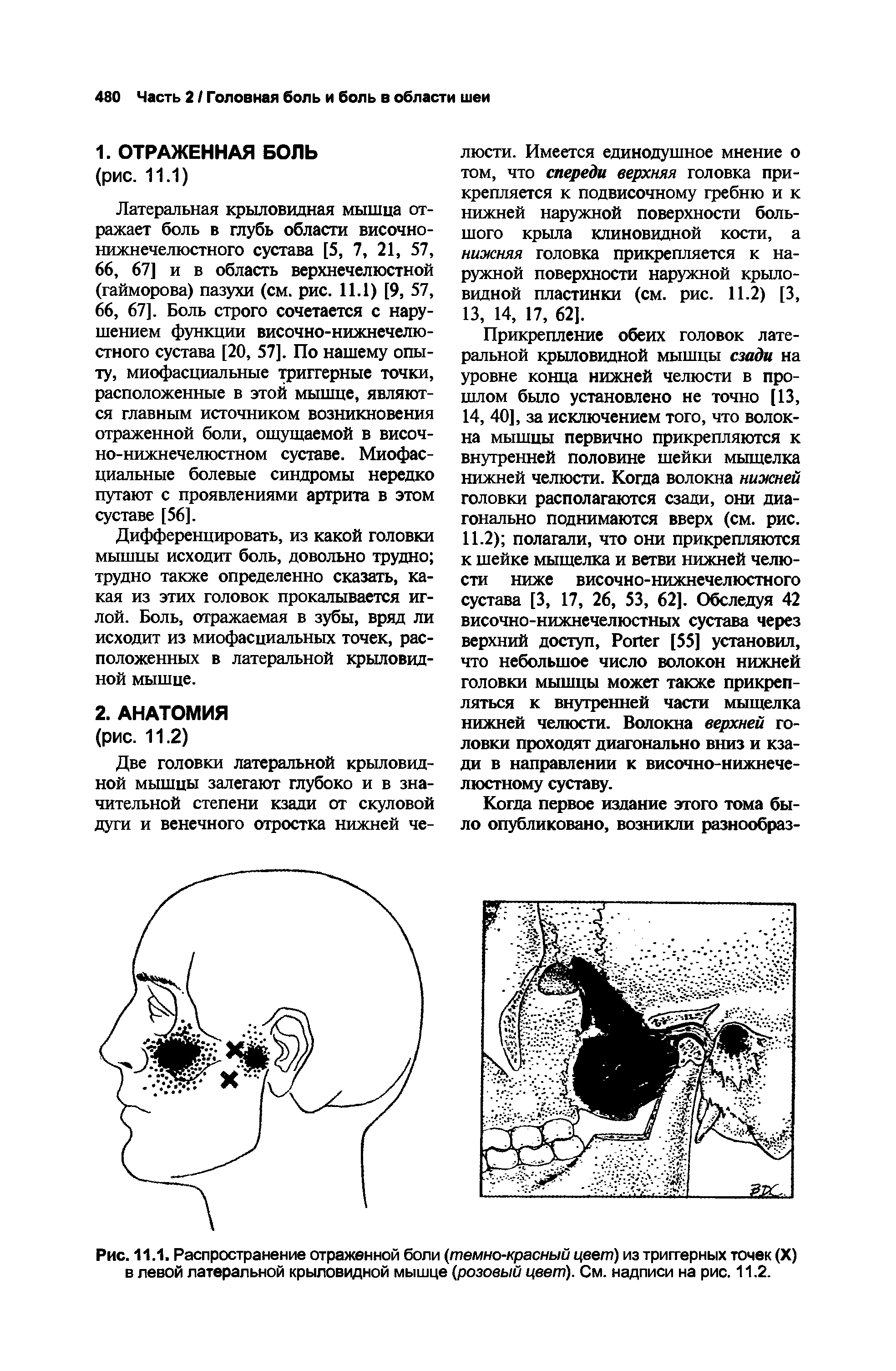 Рис. 11.1. Распространение отраженной боли (темно-красный цвет) из триггерных точек (X) в левой латеральной крыловидной мышце (розовый цвет). См. надписи на рис. 11.2.