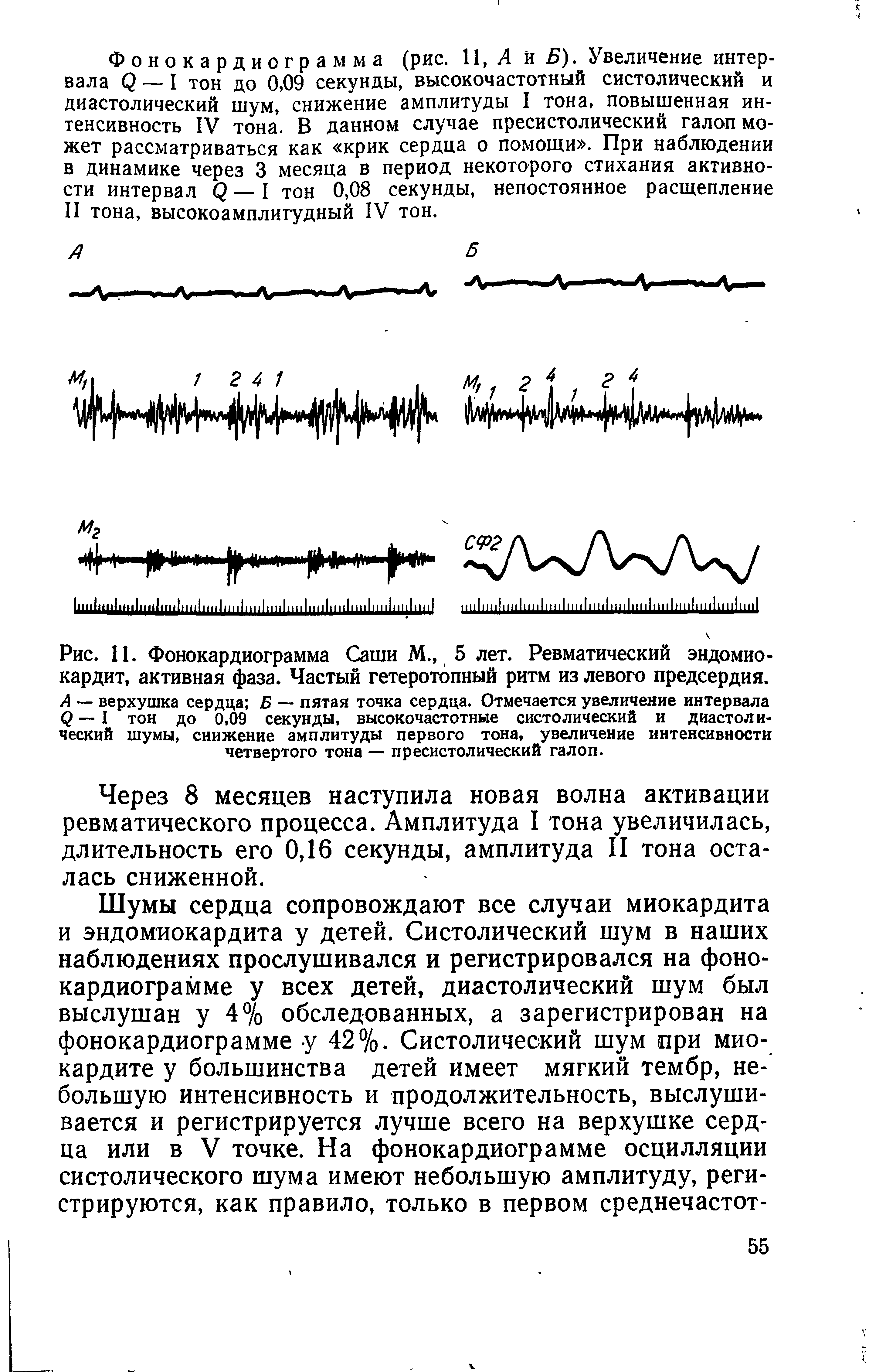 Рис. 11. Фонокардиограмма Саши М., 5 лет. Ревматический эндомиокардит, активная фаза. Частый гетеротопный ритм из левого предсердия. А — верхушка сердца Б — пятая точка сердца. Отмечается увеличение интервала <2 — I тон до 0,09 секунды, высокочастотные систолический и диастолический шумы, снижение амплитуды первого тона, увеличение интенсивности четвертого тона — пресистолический галоп.