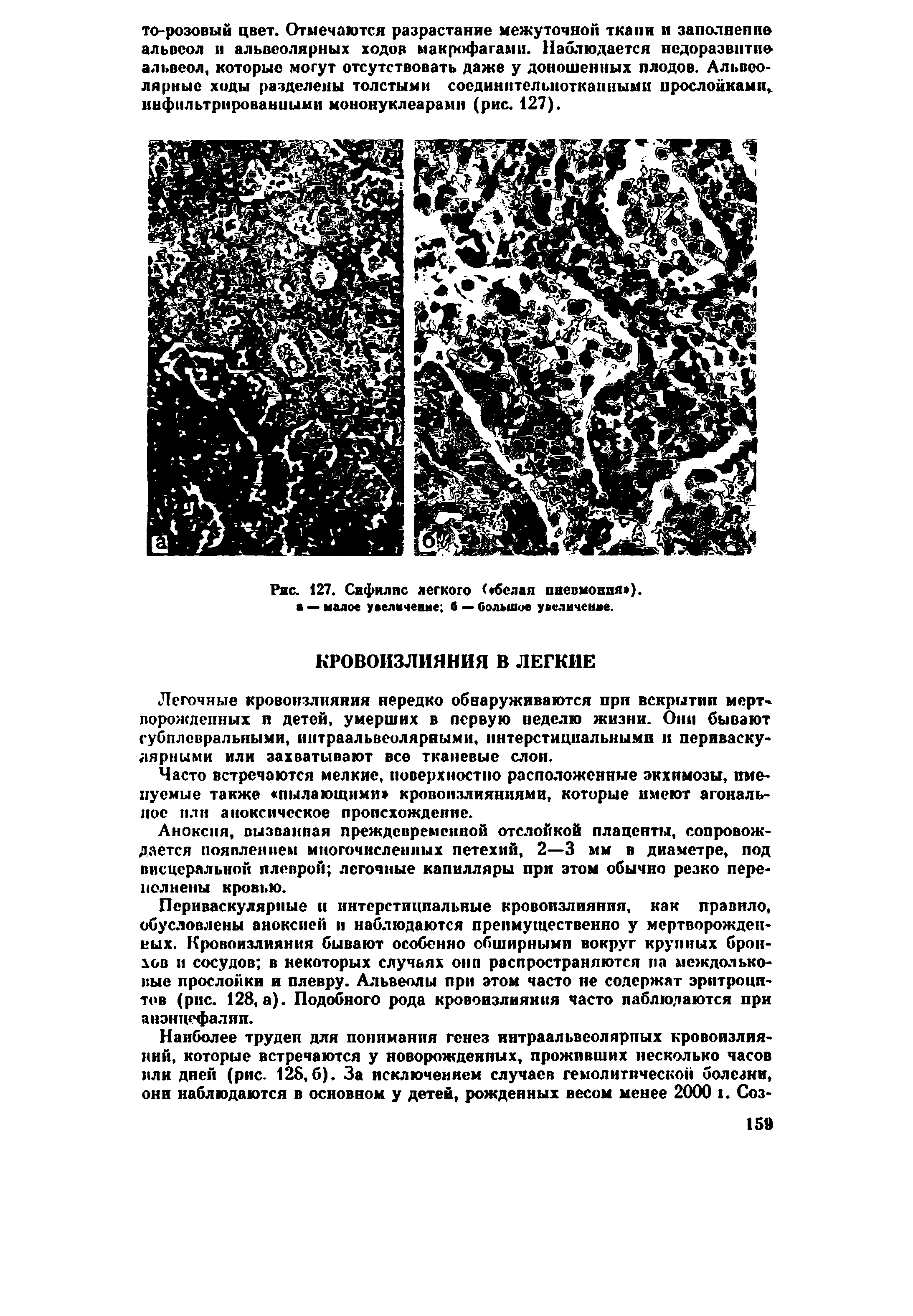 Рис. 127. Сифилис легкого ( белая пневмония ), а — малое уаелачение б — большое увеличение.