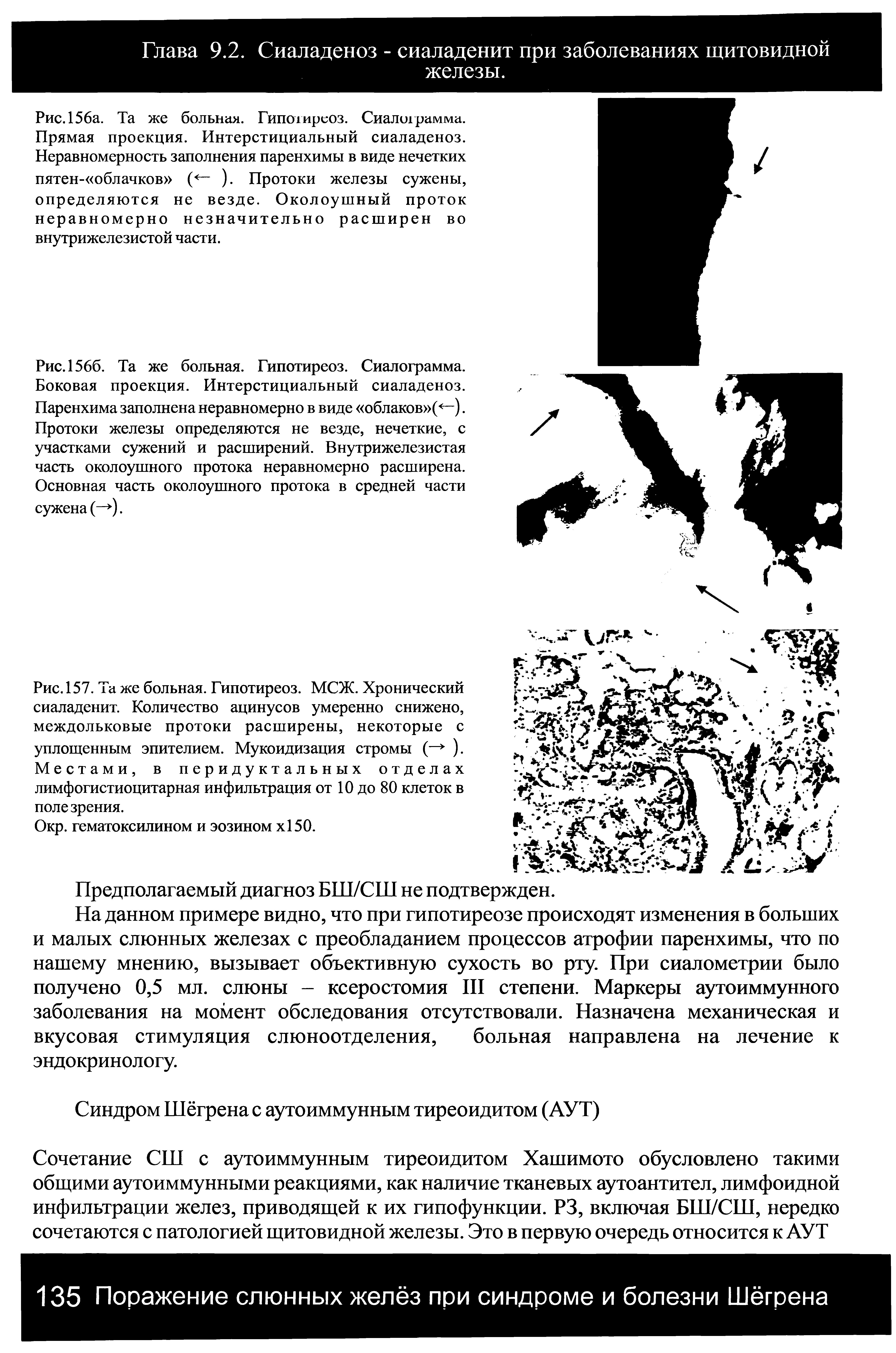 Рис. 157. Та же больная. Гипотиреоз. МСЖ. Хронический сиаладенит. Количество ацинусов умеренно снижено, междольковые протоки расширены, некоторые с уплощенным эпителием. Мукоидизация стромы (— ). Местами, в перидуктальных отделах лимфогистиоцитарная инфильтрация от 10 до 80 клеток в полезрения.