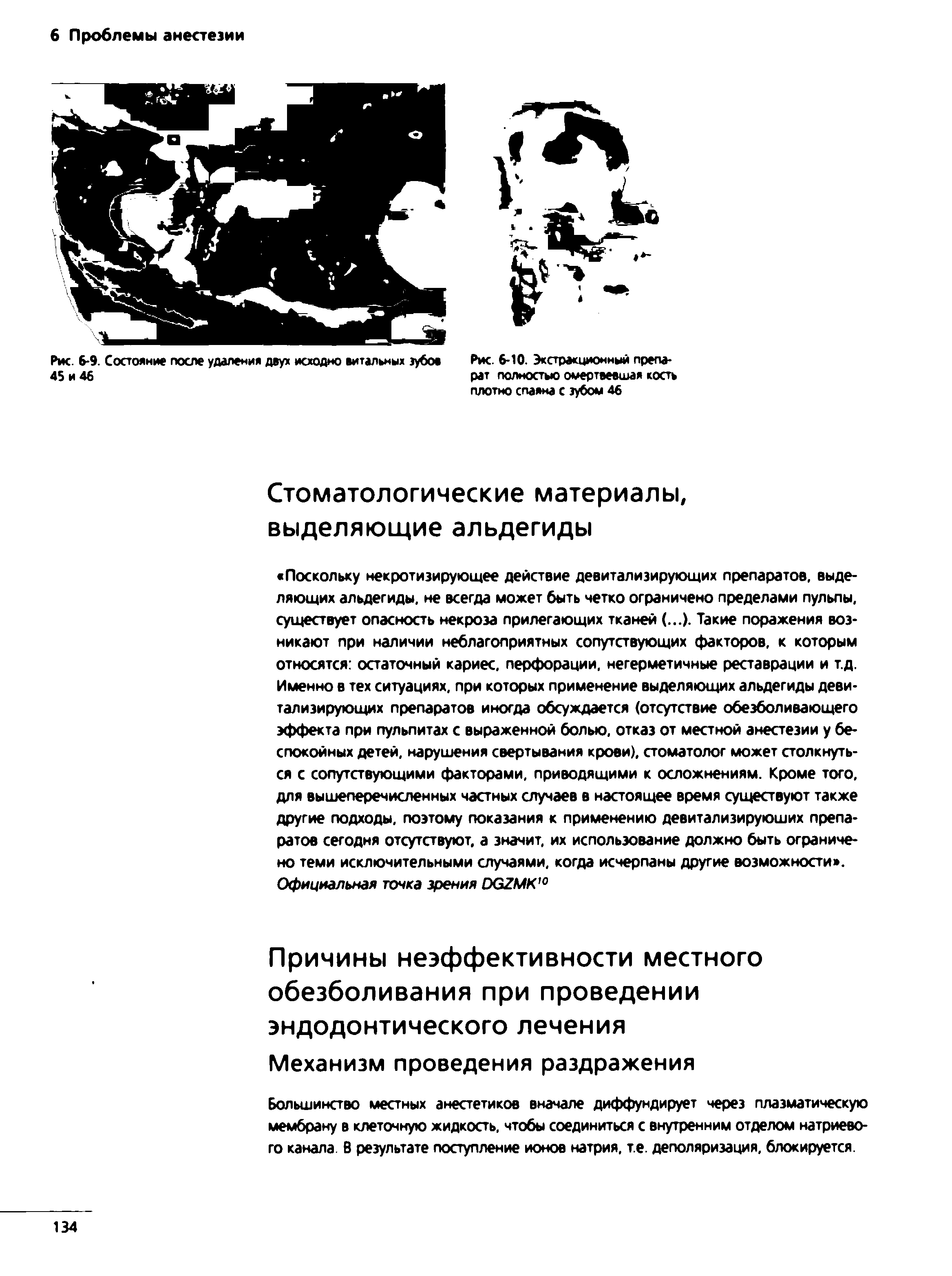 Рис. 6-10. Экстракционный препарат полностью омертвевшая кость плотно спаяна с зубом 46...