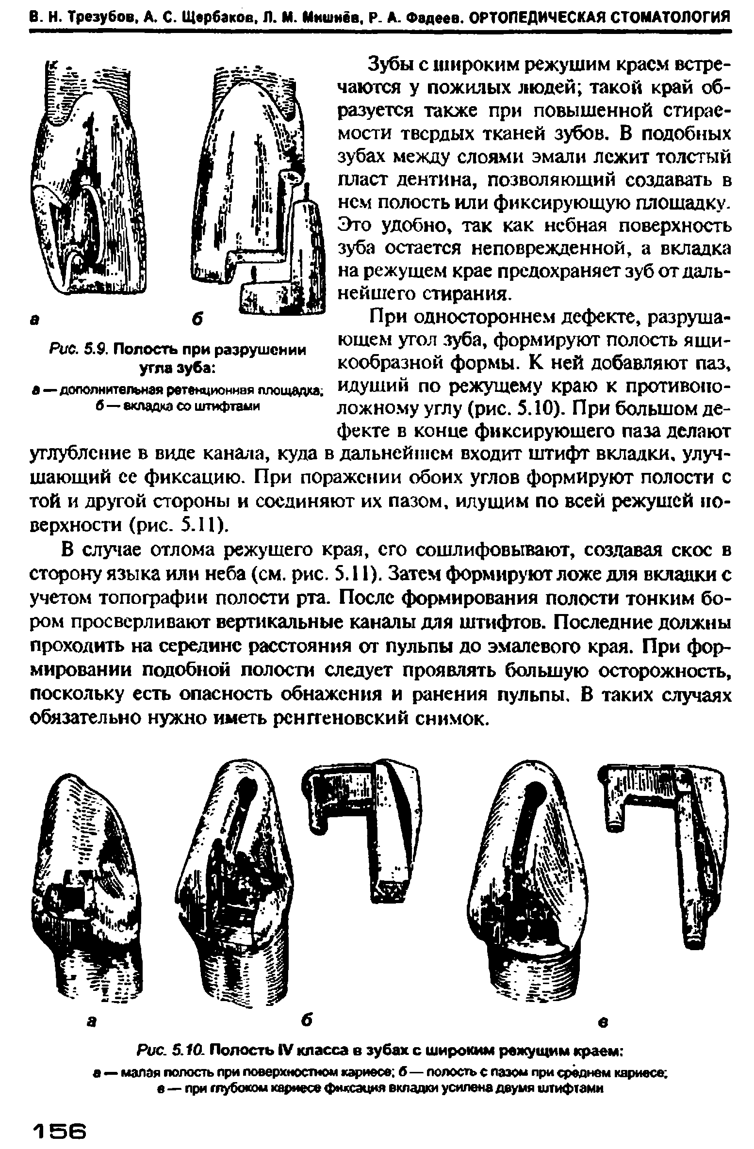 Рис. 5.10. Полость IV класса в зубах с широким режущим краем ...