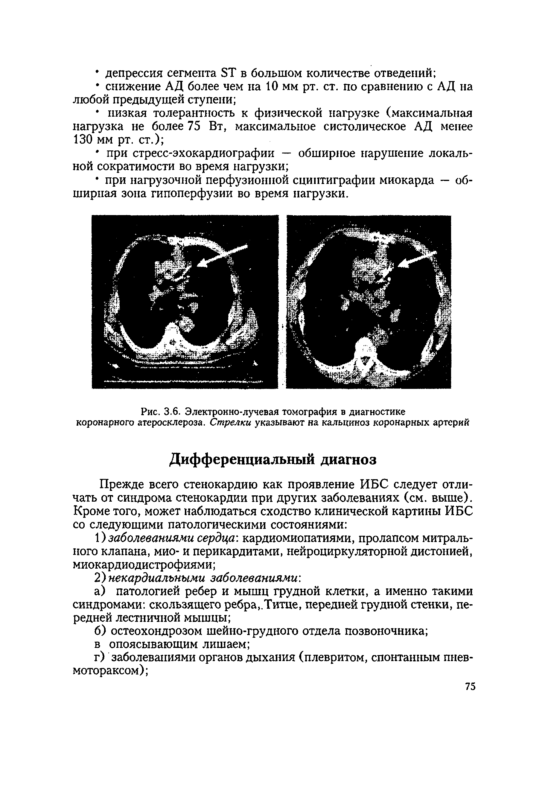Рис. 3.6. Электронно-лучевая томография в диагностике коронарного атеросклероза. Стрелки указывают на кальциноз коронарных артерий...