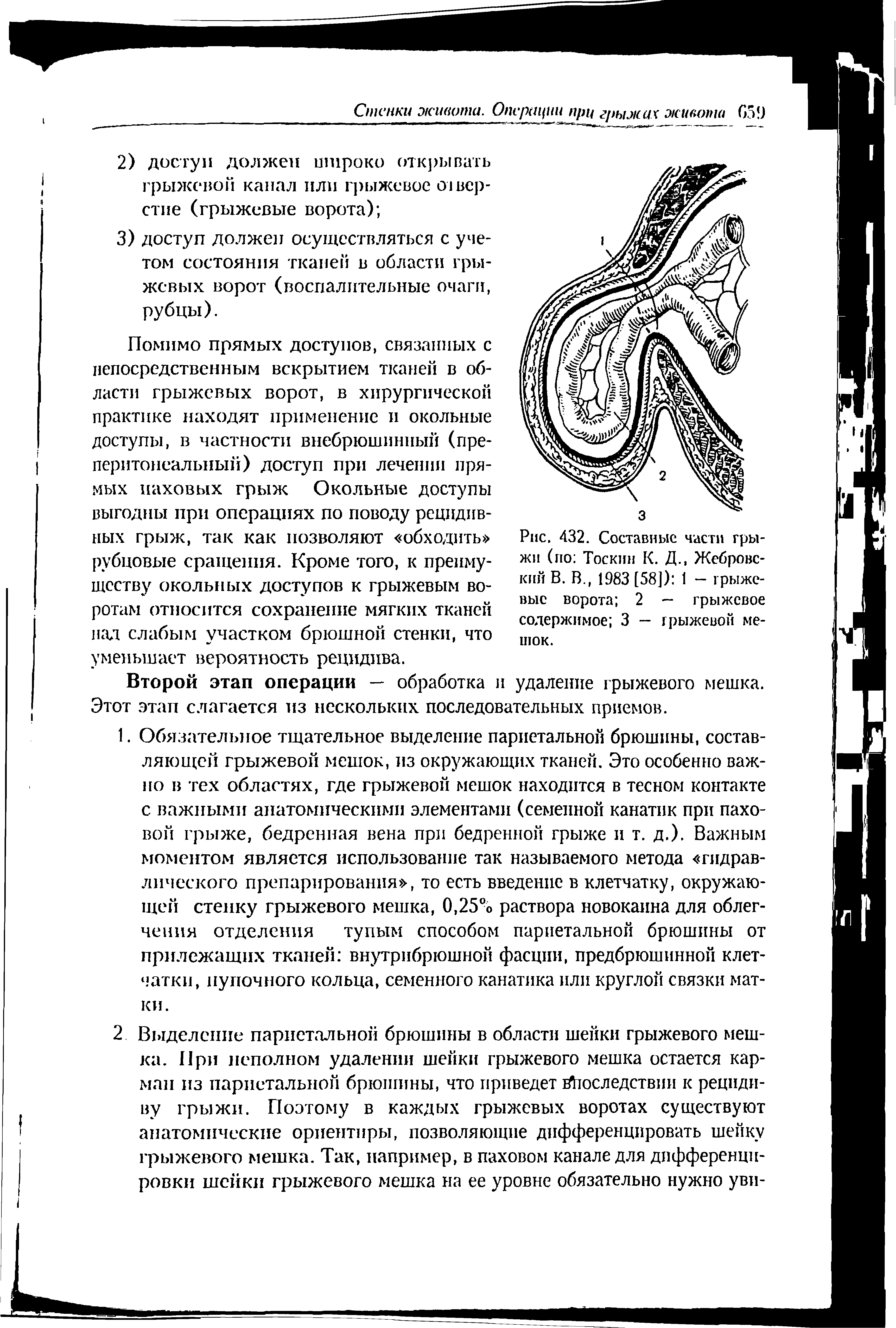 Рис. 432. Составные части грыжи (по Тоскин К. Д., Жебровский В. В., 1983 [58]) 1 — грыжевые ворота 2 — грыжевое...