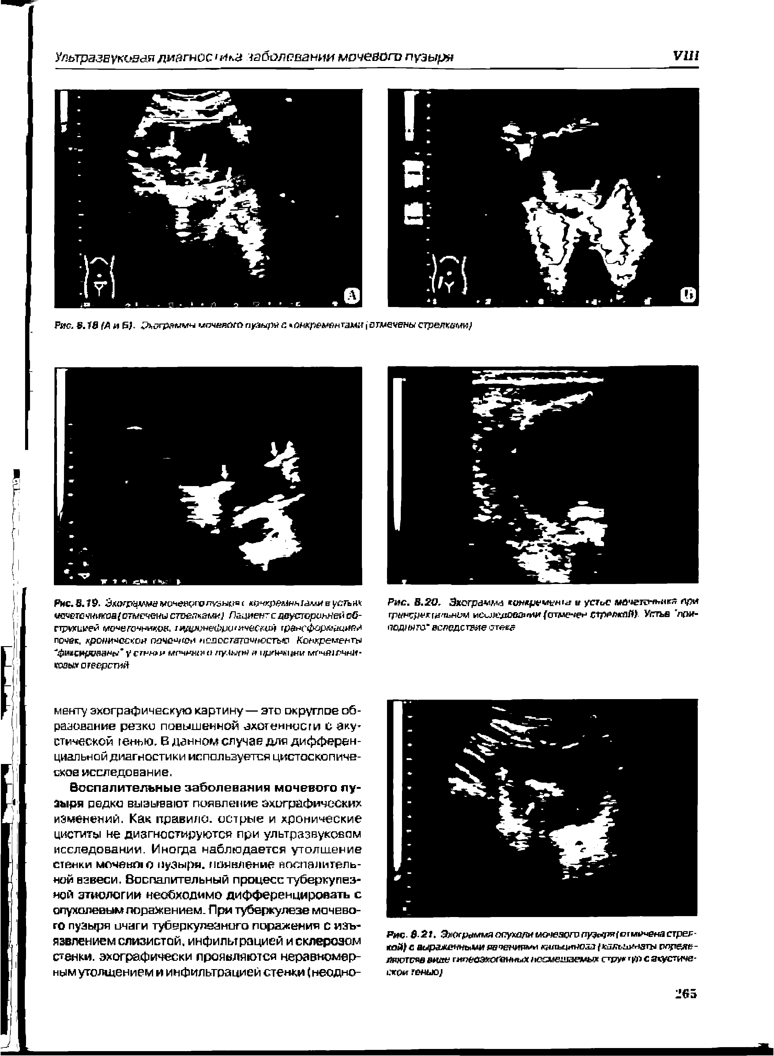 Рис. 6.21. Эхырыммя ппуха/ги моиезого пузыря с г мечена стрел -коА) с выраженными печениями кцльциноаа ктльз негы ллдея -ляютгяв аше аэрогенных несмешаемых струг гул с асустиче- .T№ тенью)...