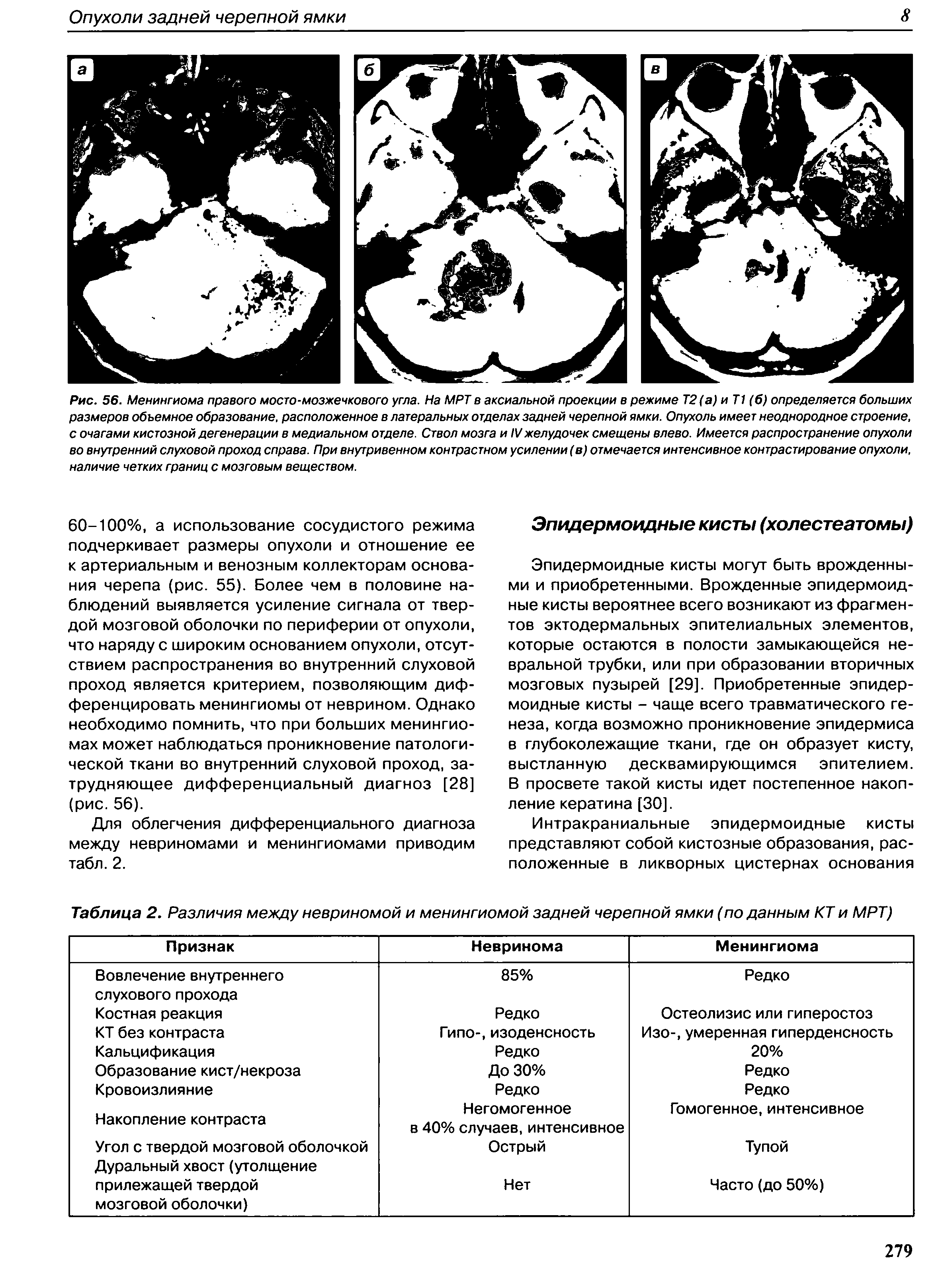 Таблица 2. Различия между невриномой и менингиомой задней черепной ямки (по данным КТ и МРТ)...