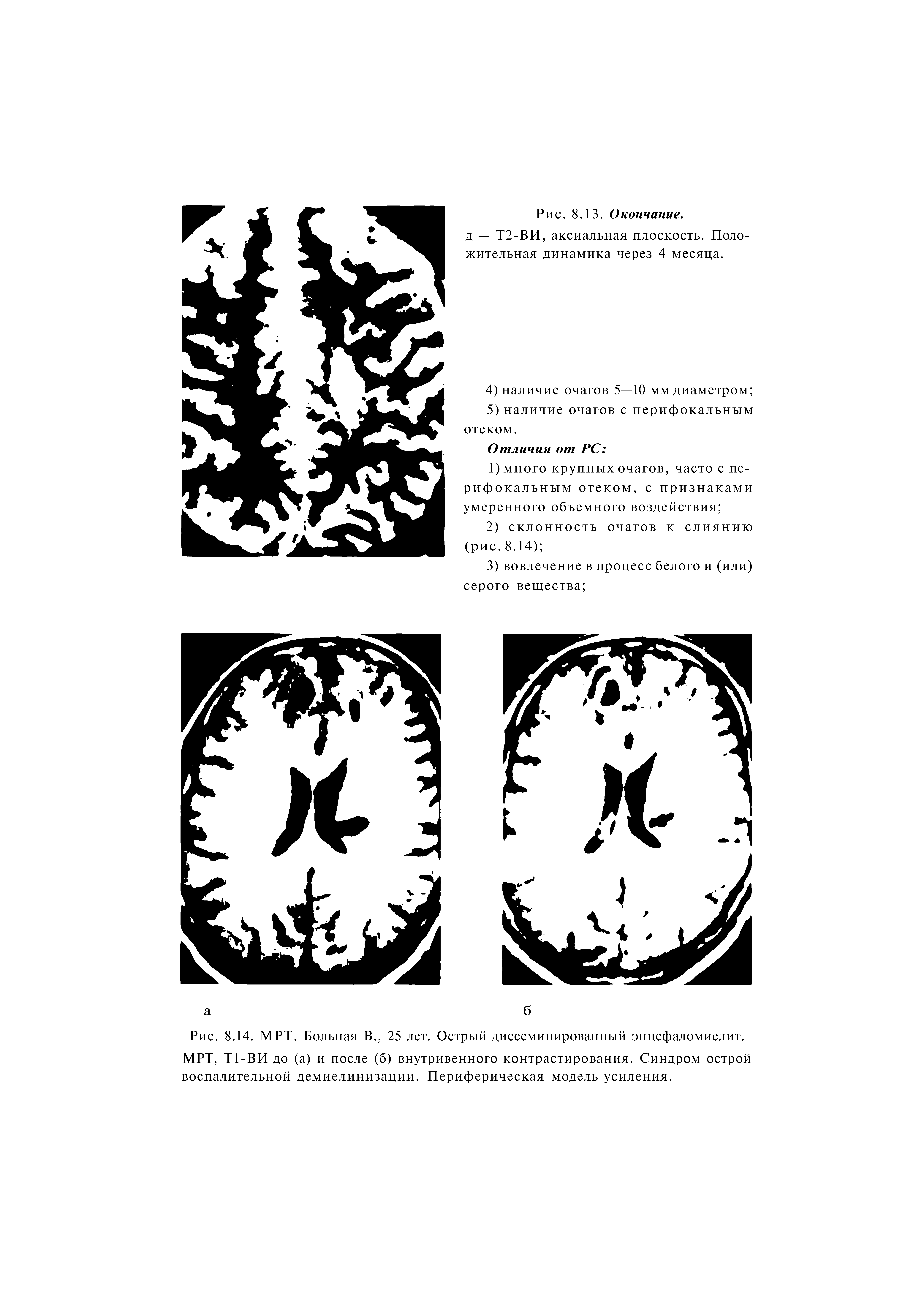 Рис. 8.14. МРТ. Больная В., 25 лет. Острый диссеминированный энцефаломиелит. МРТ, Т1-ВИ до (а) и после (б) внутривенного контрастирования. Синдром острой воспалительной демиелинизации. Периферическая модель усиления.