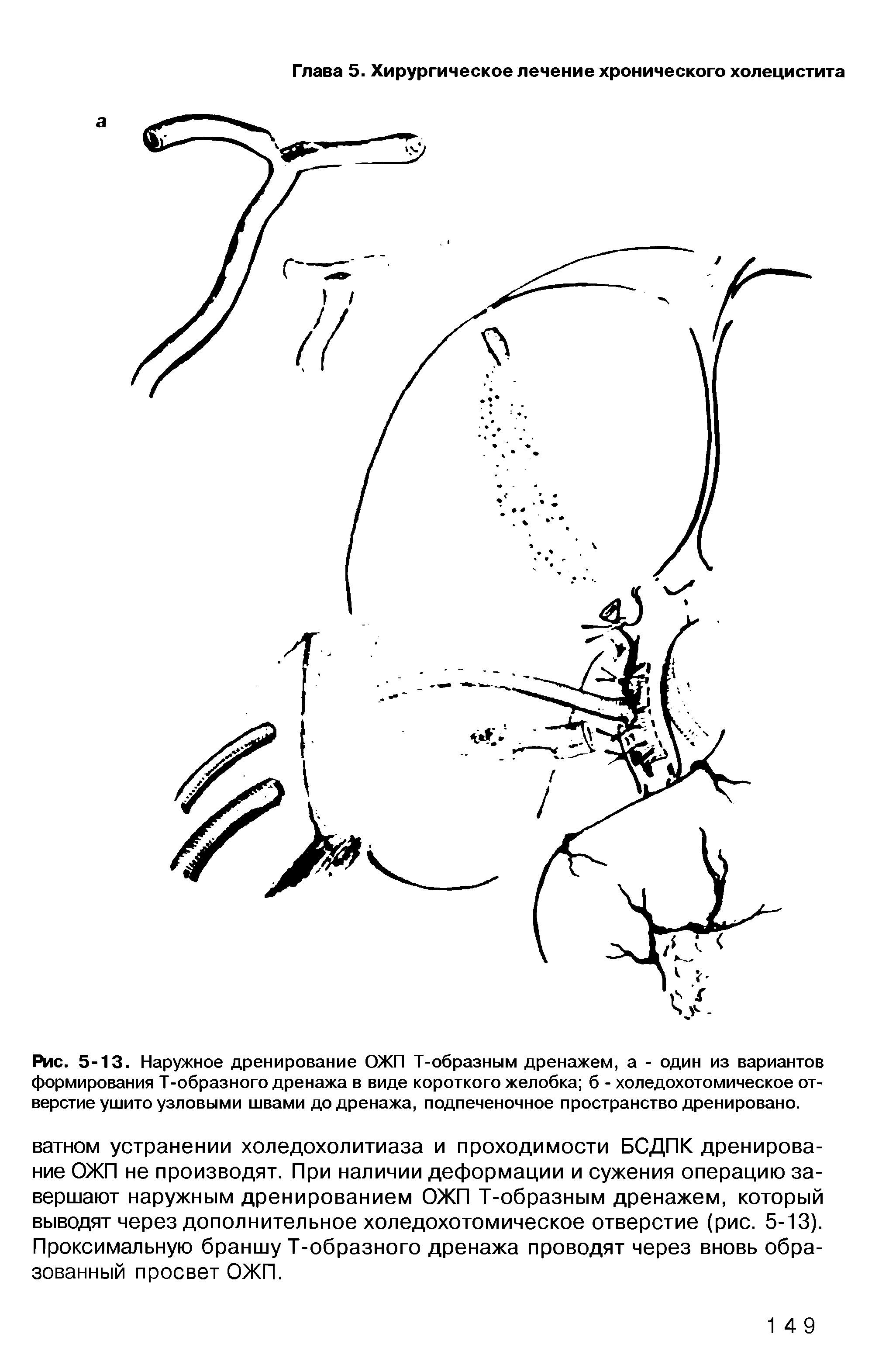 Рис. 5-13. Наружное дренирование ОЖП Т-образным дренажем, а - один из вариантов формирования Т-образного дренажа в виде короткого желобка б - холедохотомическое отверстие ушито узловыми швами до дренажа, подпеченочное пространство дренировано.