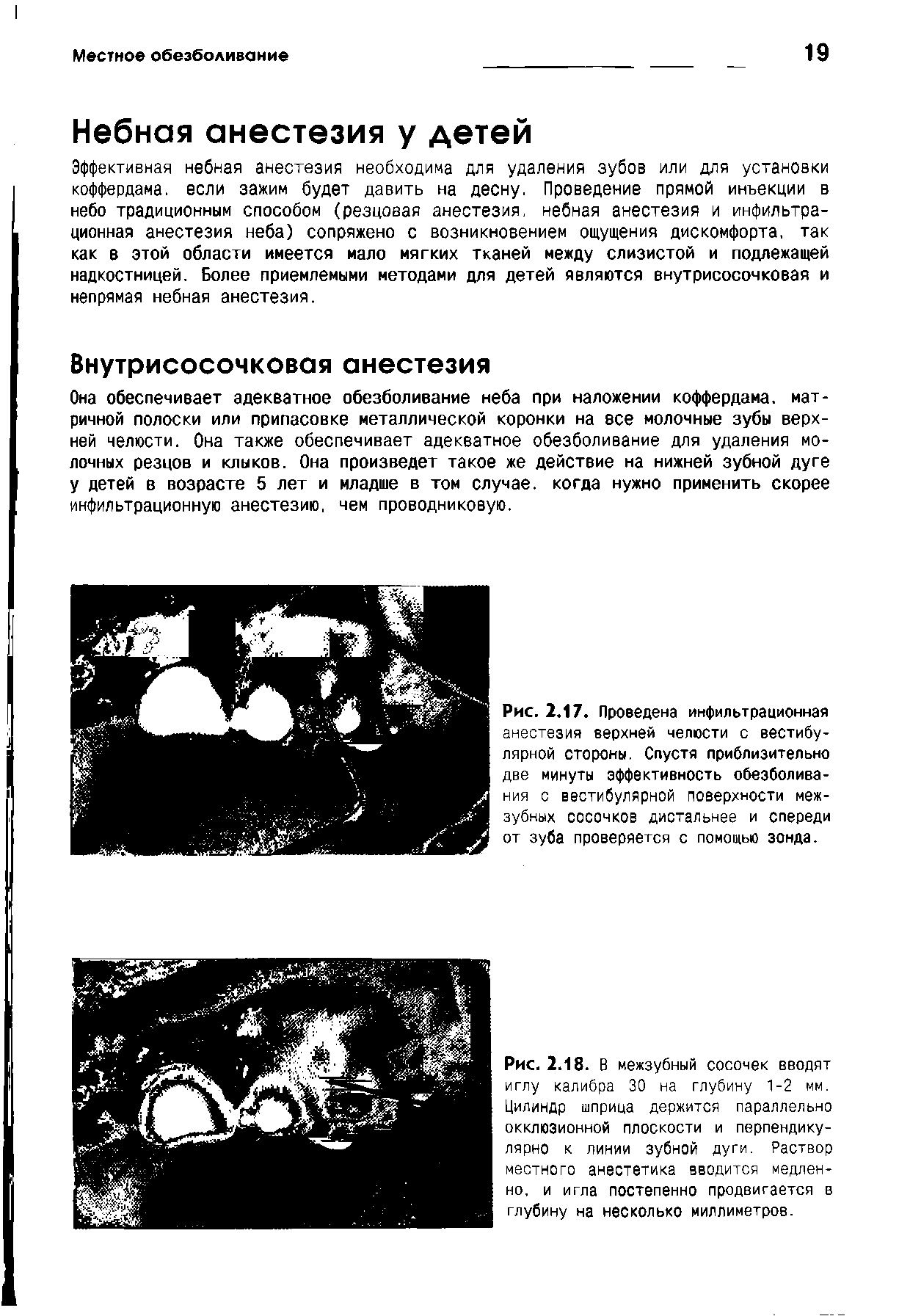 Рис. 2.17. Проведена инфильтрационная анестезия верхней челюсти с вестибулярной стороны. Спустя приблизительно две минуты эффективность обезболивания с вестибулярной поверхности межзубных сосочков дистальнее и спереди от зуба проверяется с помощью зонда.