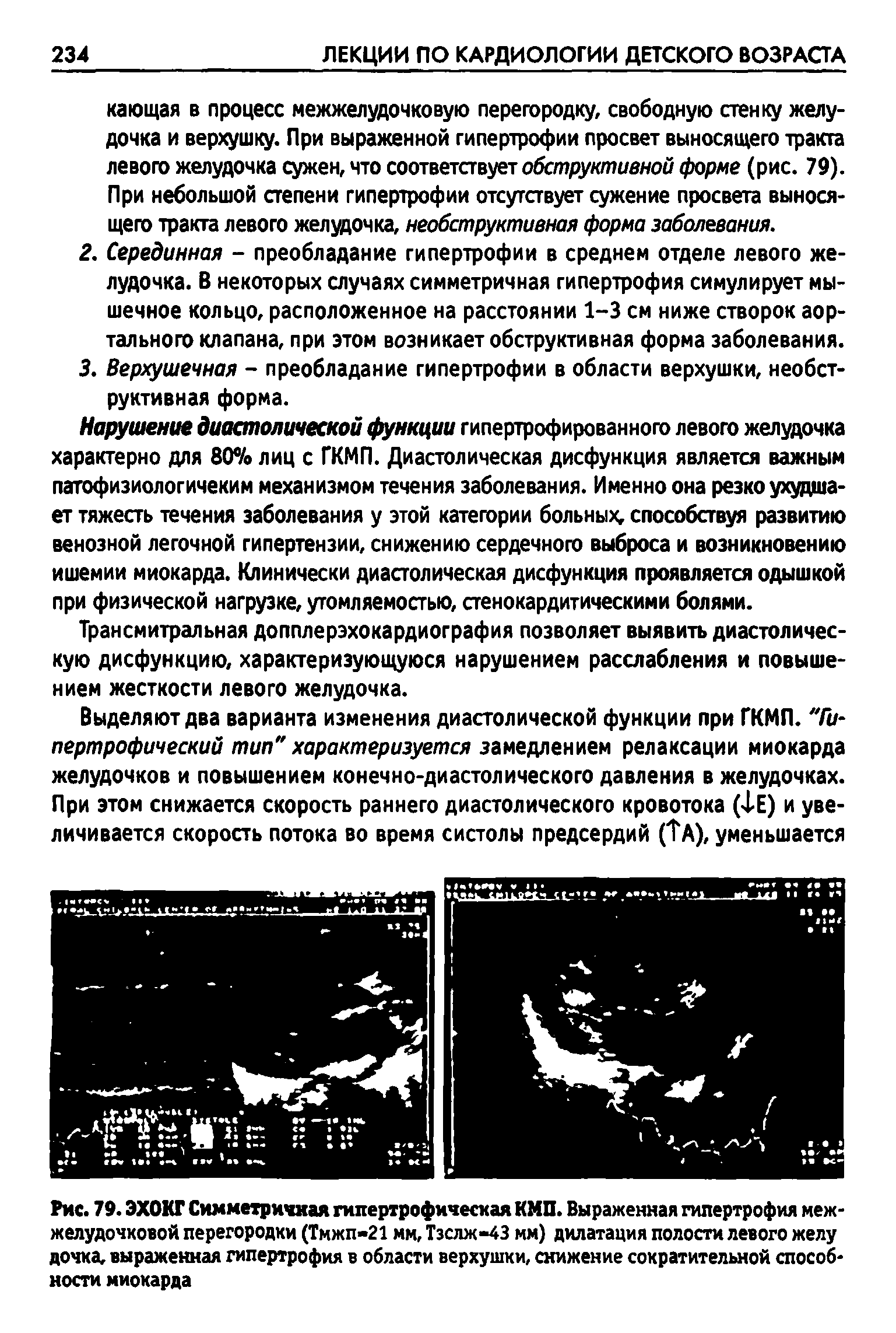 Рис. 79. ЭХОКГ Симметричная гипертрофическая КМП. Выраженная гипертрофия межжелудочковой перегородки (Тмжп-21 мм, Тзслж-43 мм) дилатация полости левого желу дочка, выраженная гипертрофия в области верхушки, снижение сократительной способности миокарда...