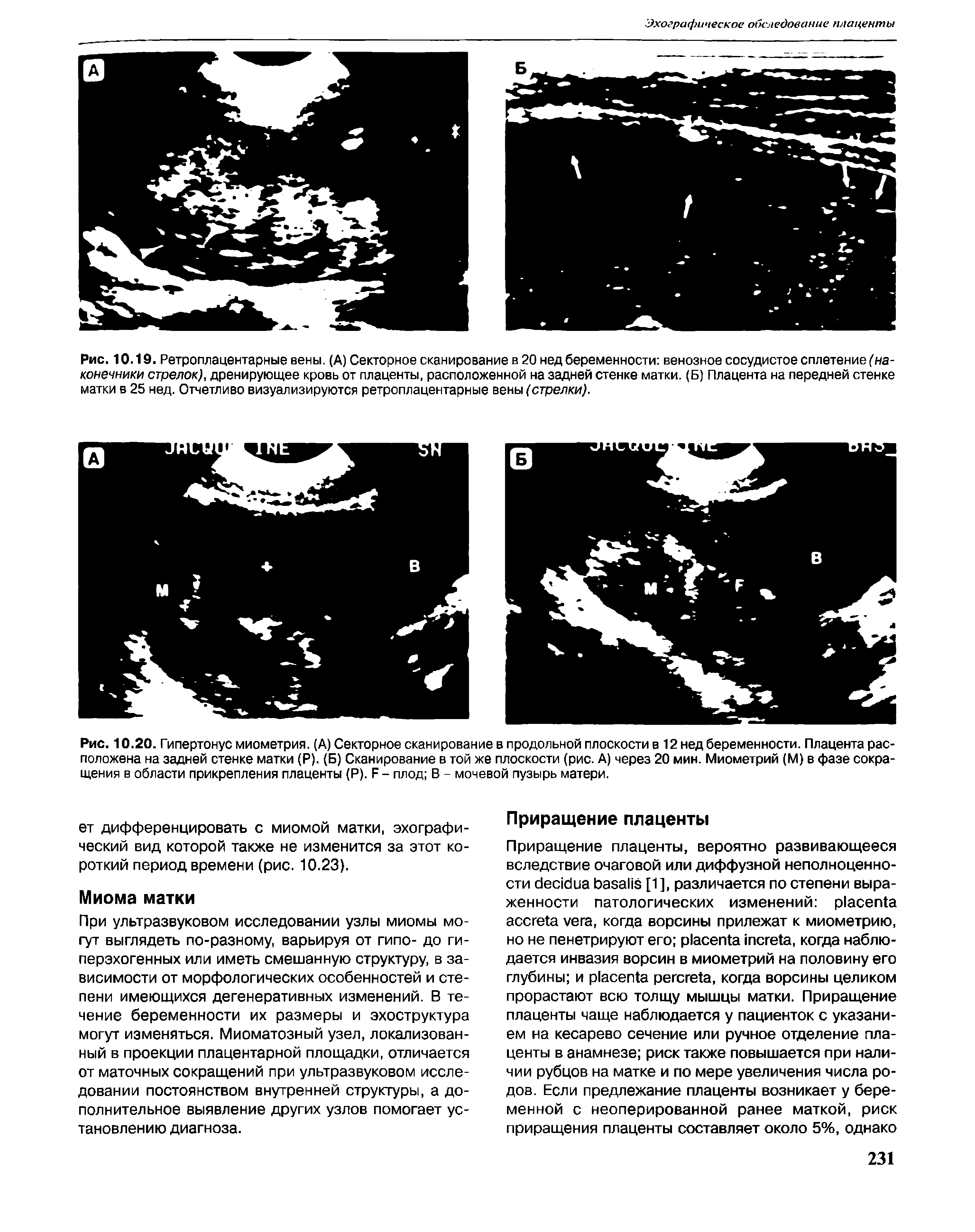 Рис. 10.20. Гипертонус миометрия. (А) Секторное сканирование в продольной плоскости в 12 нед беременности. Плацента расположена на задней стенке матки (Р). (Б) Сканирование в той же плоскости (рис. А) через 20 мин. Миометрий (М) в фазе сокращения в области прикрепления плаценты (Р). Р - плод В - мочевой пузырь матери.