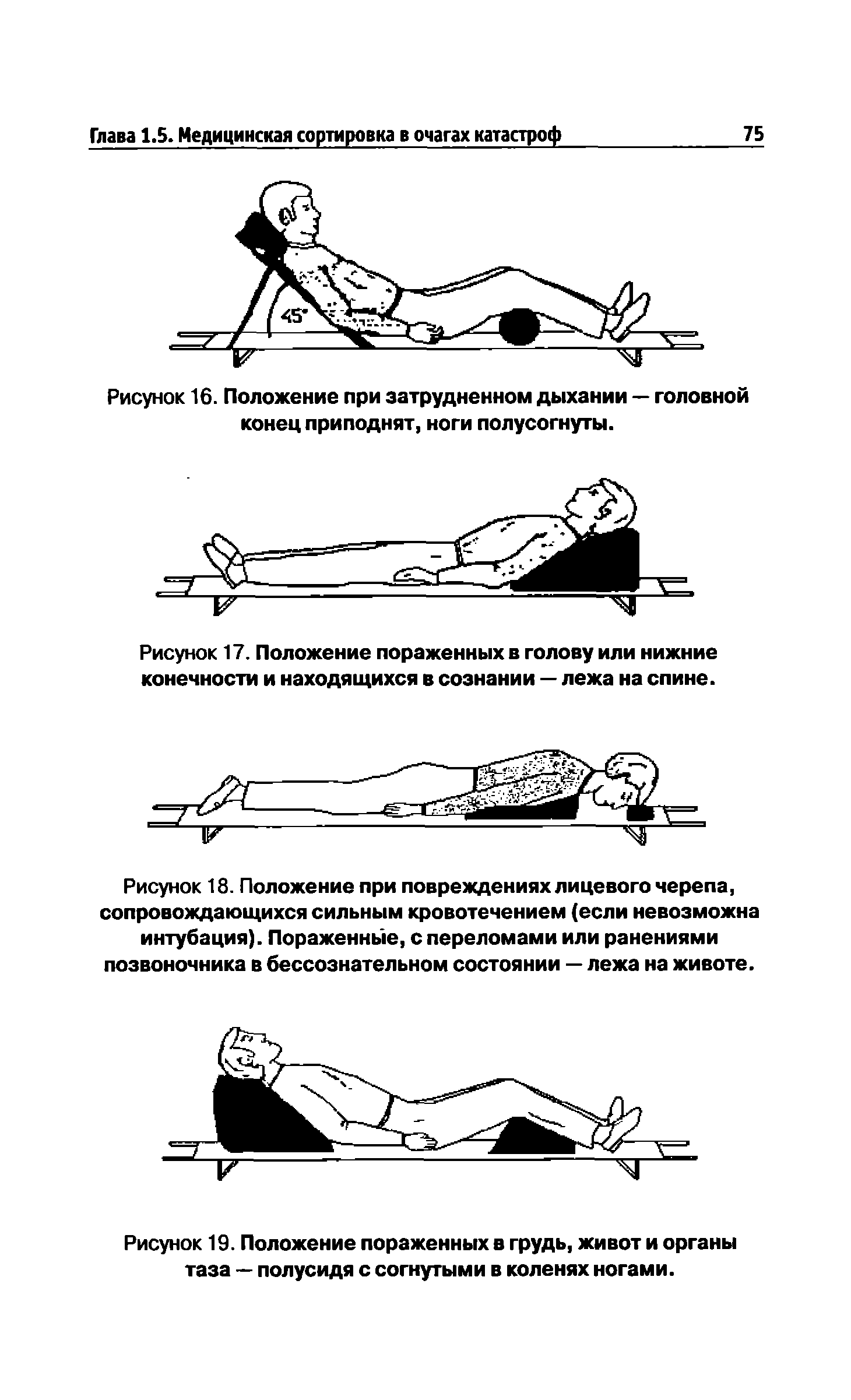 Рисунок 18. Положение при повреждениях лицевого черепа, сопровождающихся сильным кровотечением (если невозможна интубация). Пораженные, с переломами или ранениями позвоночника в бессознательном состоянии — лежа на животе.