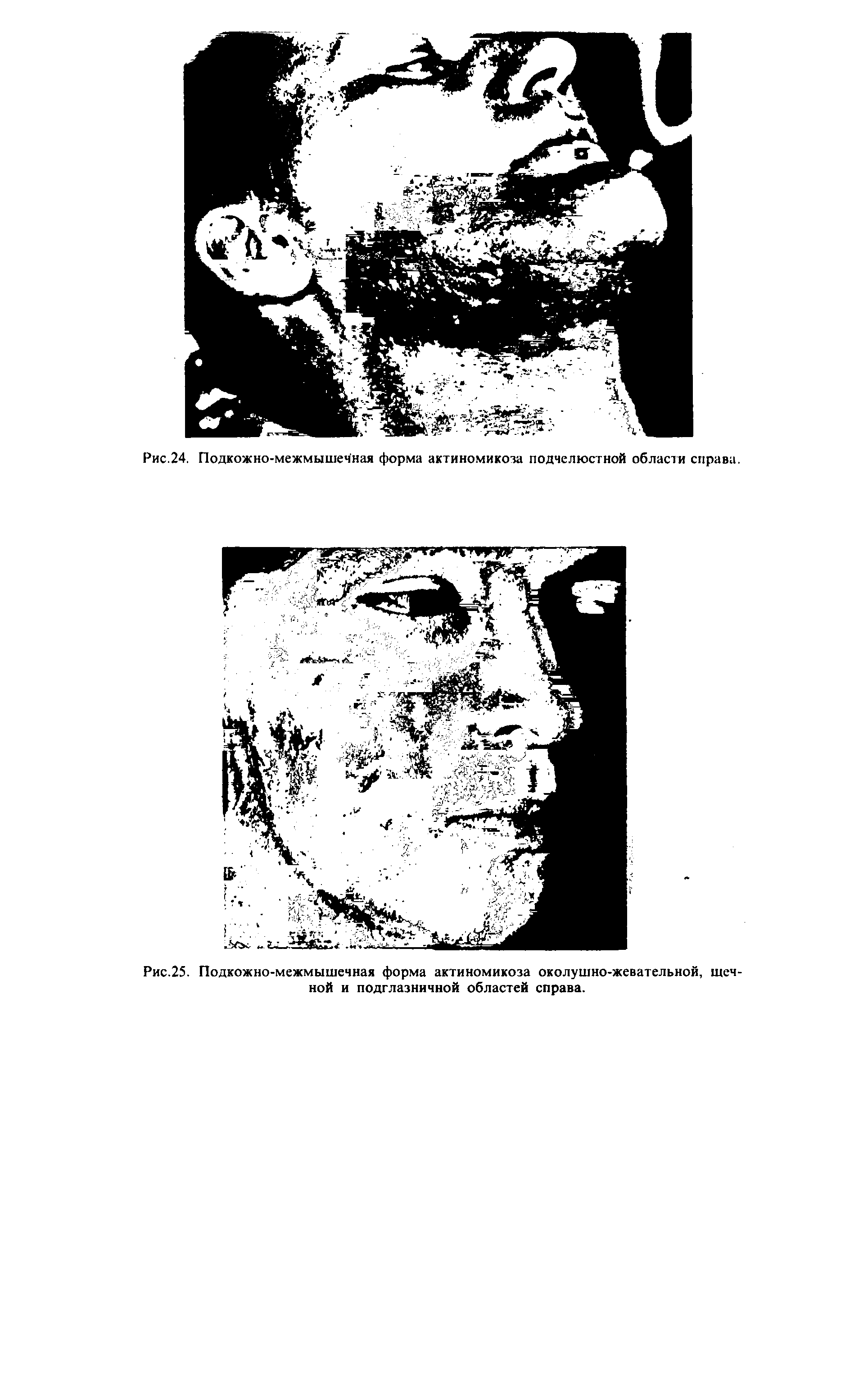 Рис.25. Подкожно-межмышечная форма актиномикоза околушно-жевательной, щечной и подглазничной областей справа.