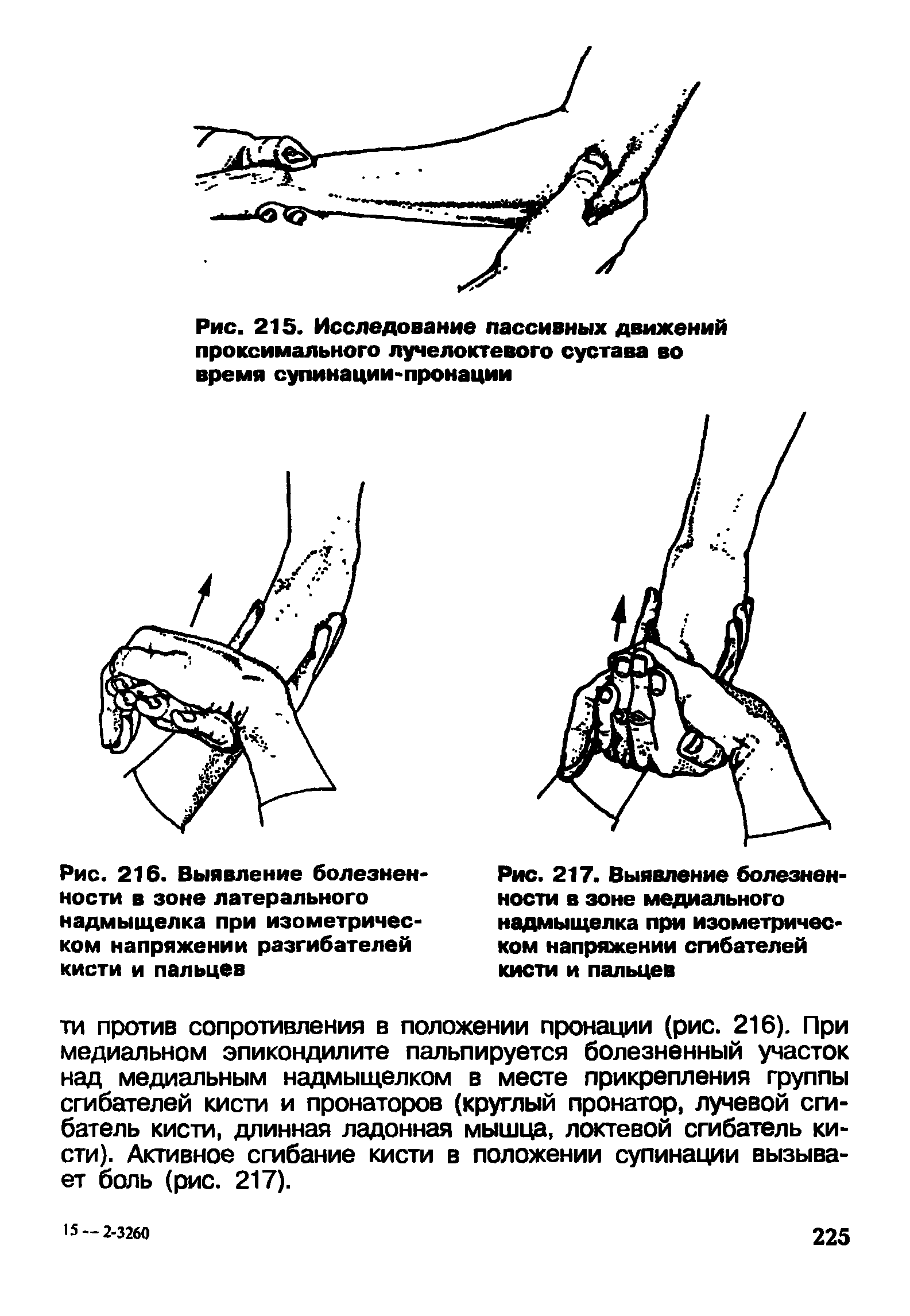 Рис. 217. Выявление болезненности в зоне медиального надмыщелка при изометрическом напряжении сгибателей кисти и пальцев...