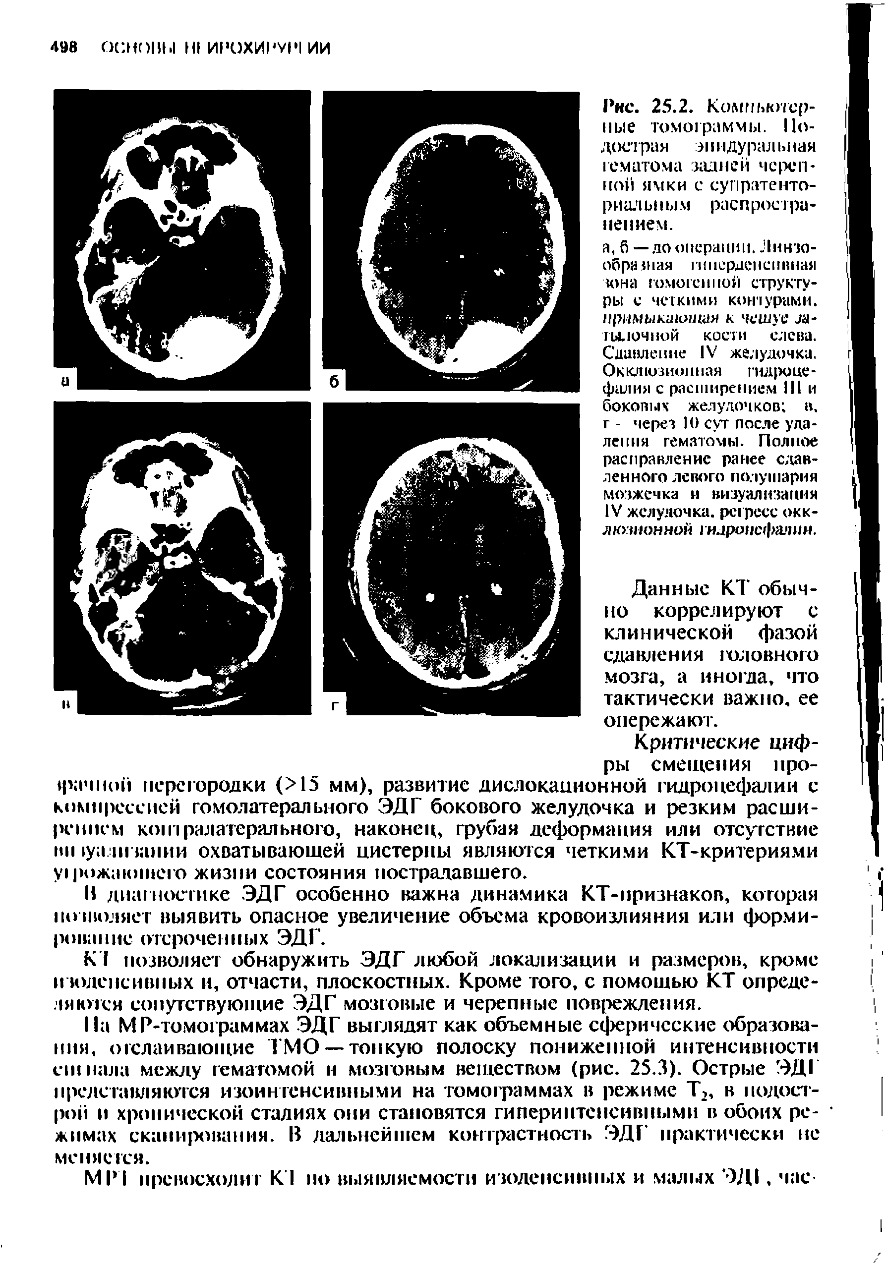 Рис. 25.2. Компьютерные томограммы. Подострая л I ндуралы 1ая гематома задней черепной ямки с супратенториальным распространением.