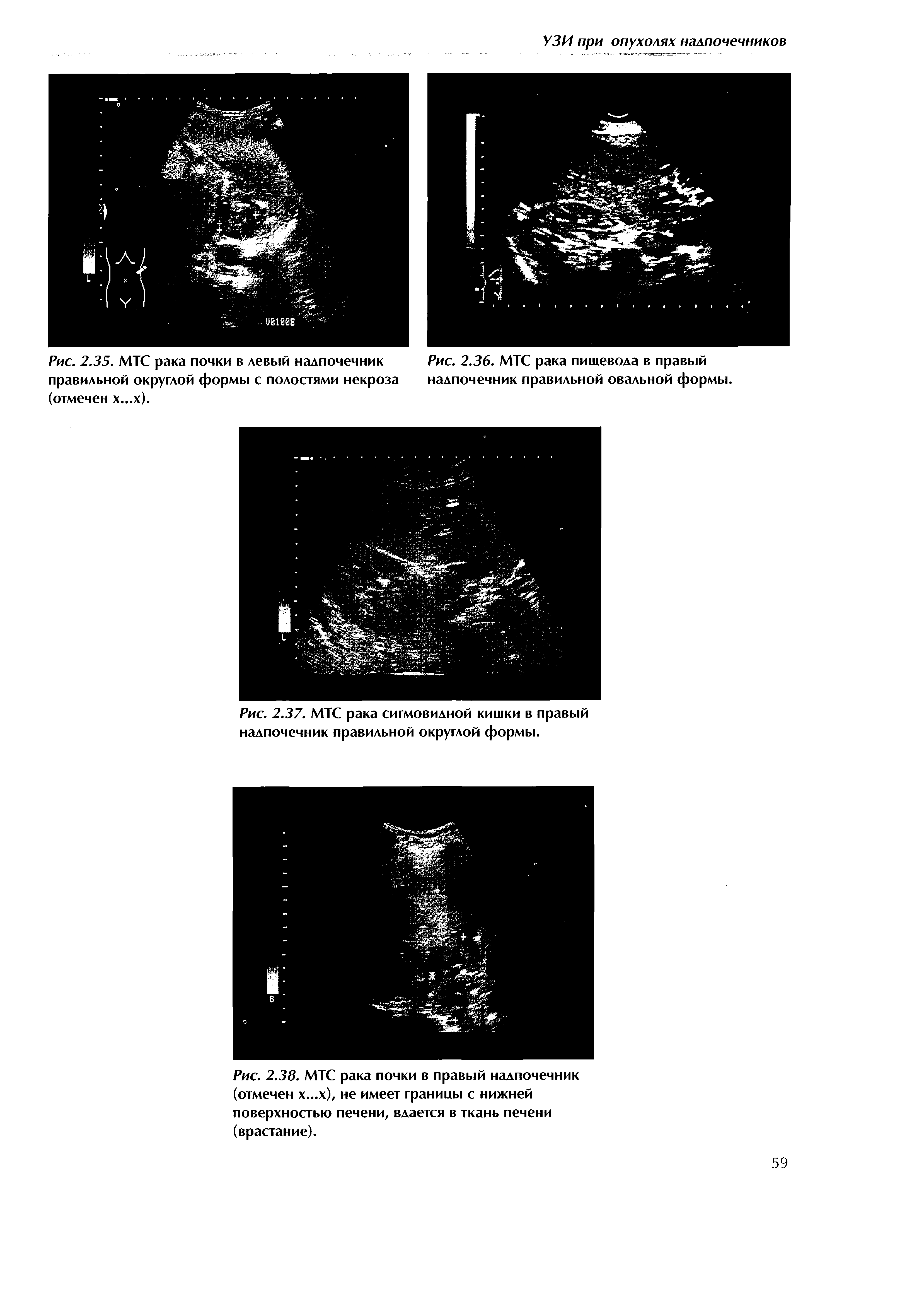 Рис. 2.35. МТС рака почки в левый надпочечник Рис. 2.36. МТС рака пищевода в правый правильной округлой формы с полостями некроза надпочечник правильной овальной формы, (отмечен х...х).