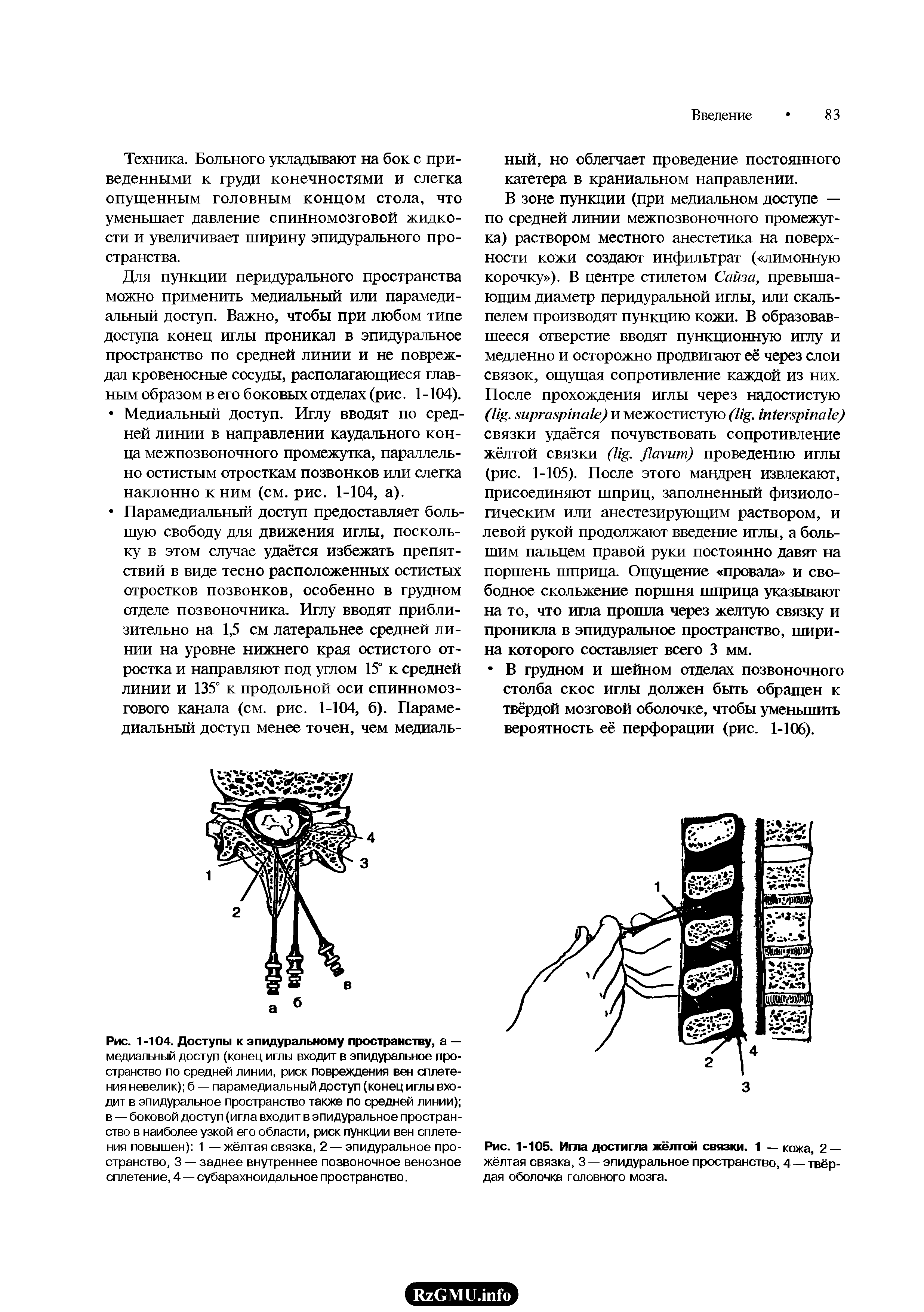 Рис. 1-105. Игла достигла жёлтой связки. 1 — кожа, 2 — жёлтая связка, 3 — эпидуральное пространство, 4—твёрдая оболочка головного мозга.