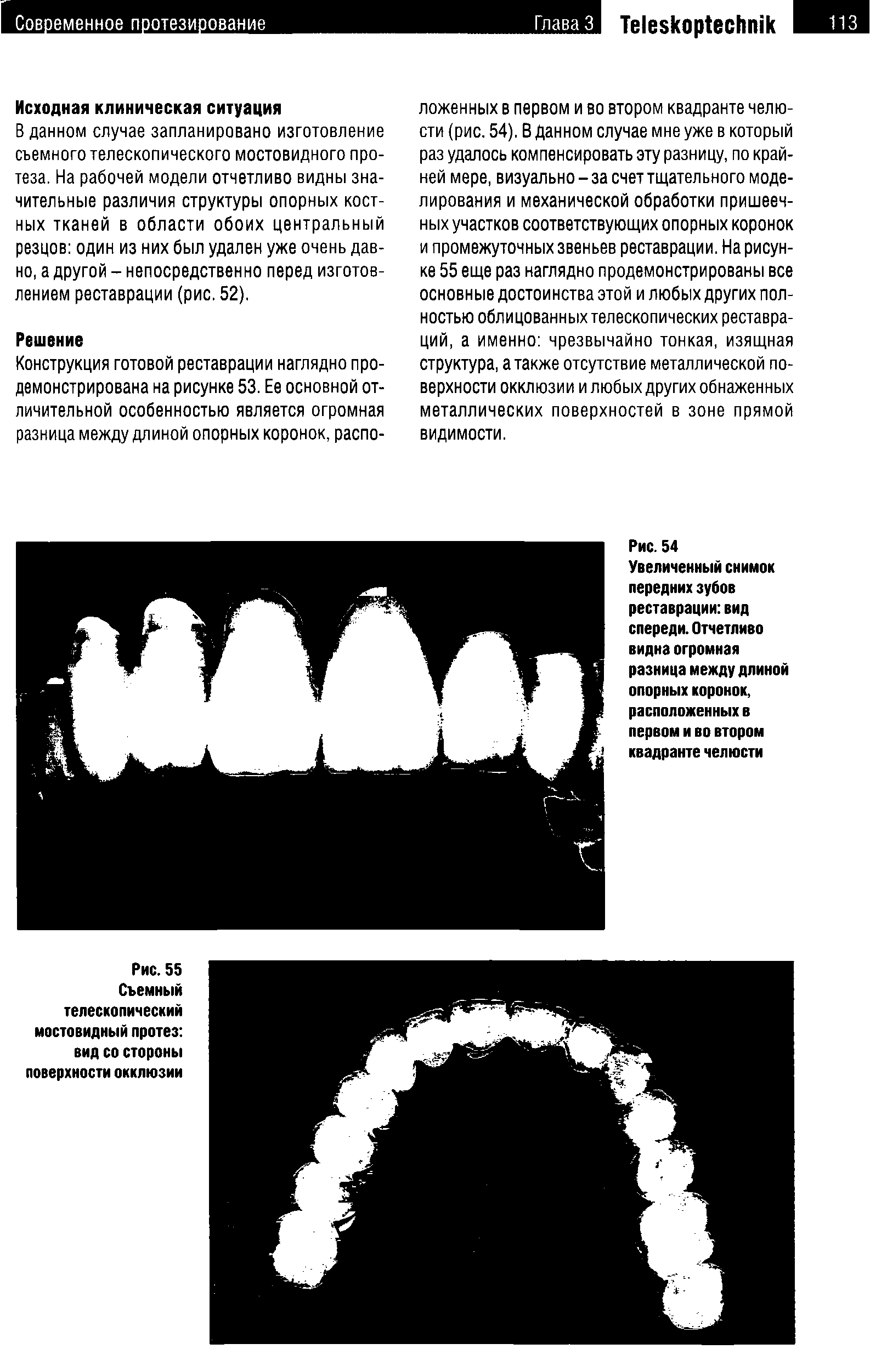 Рис. 54 Увеличенный снимок передних зубов реставрации вид спереди.Отчетливо видна огромная разница между длиной опорных коронок, расположенных в первом и во втором квадранте челюсти...