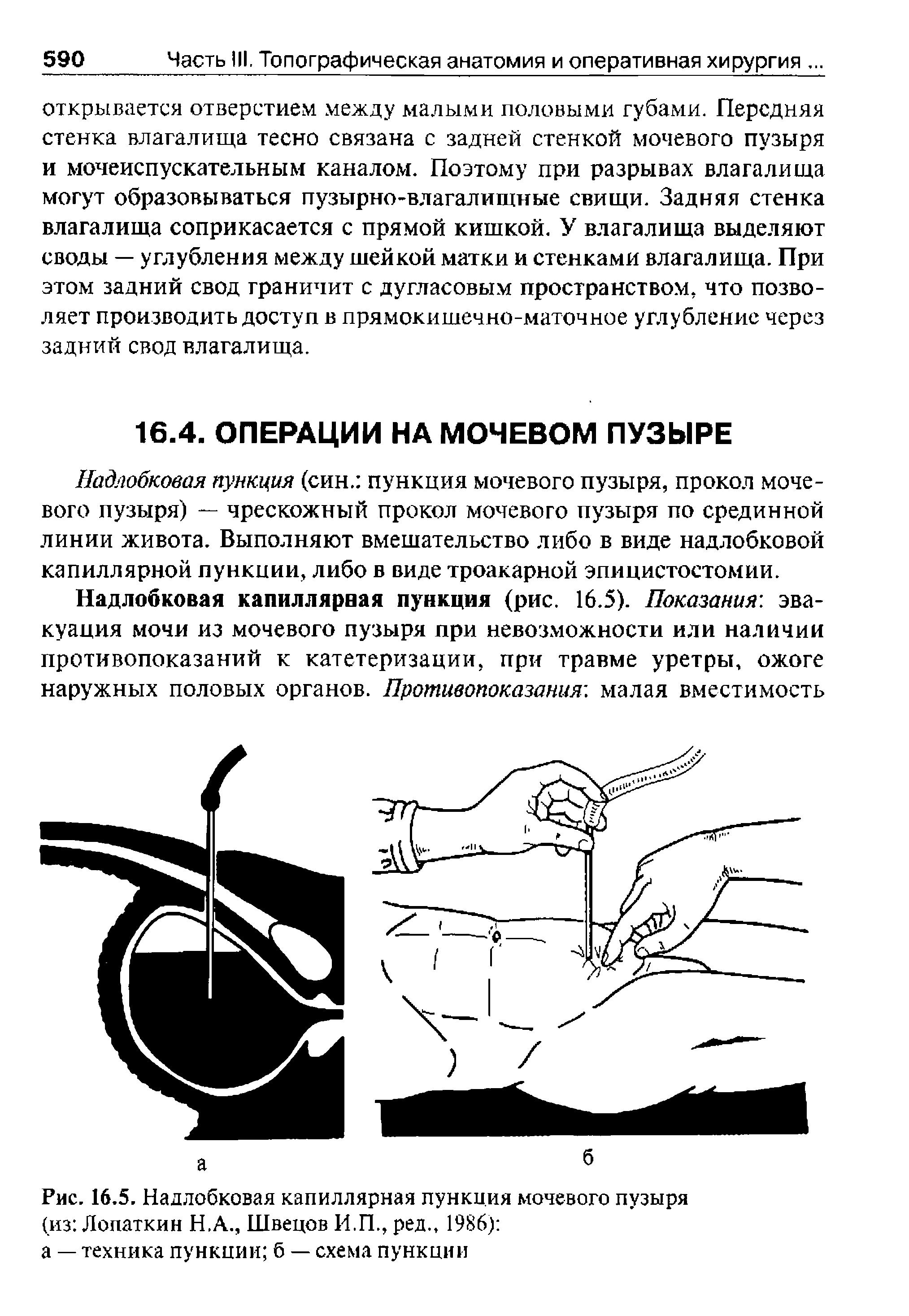 Рис. 16.5. Надлобковая капиллярная пункция мочевого пузыря (из Лопаткин Н.А., Швецов И.П., ред., 1986) а — техника пункции б — схема пункции...