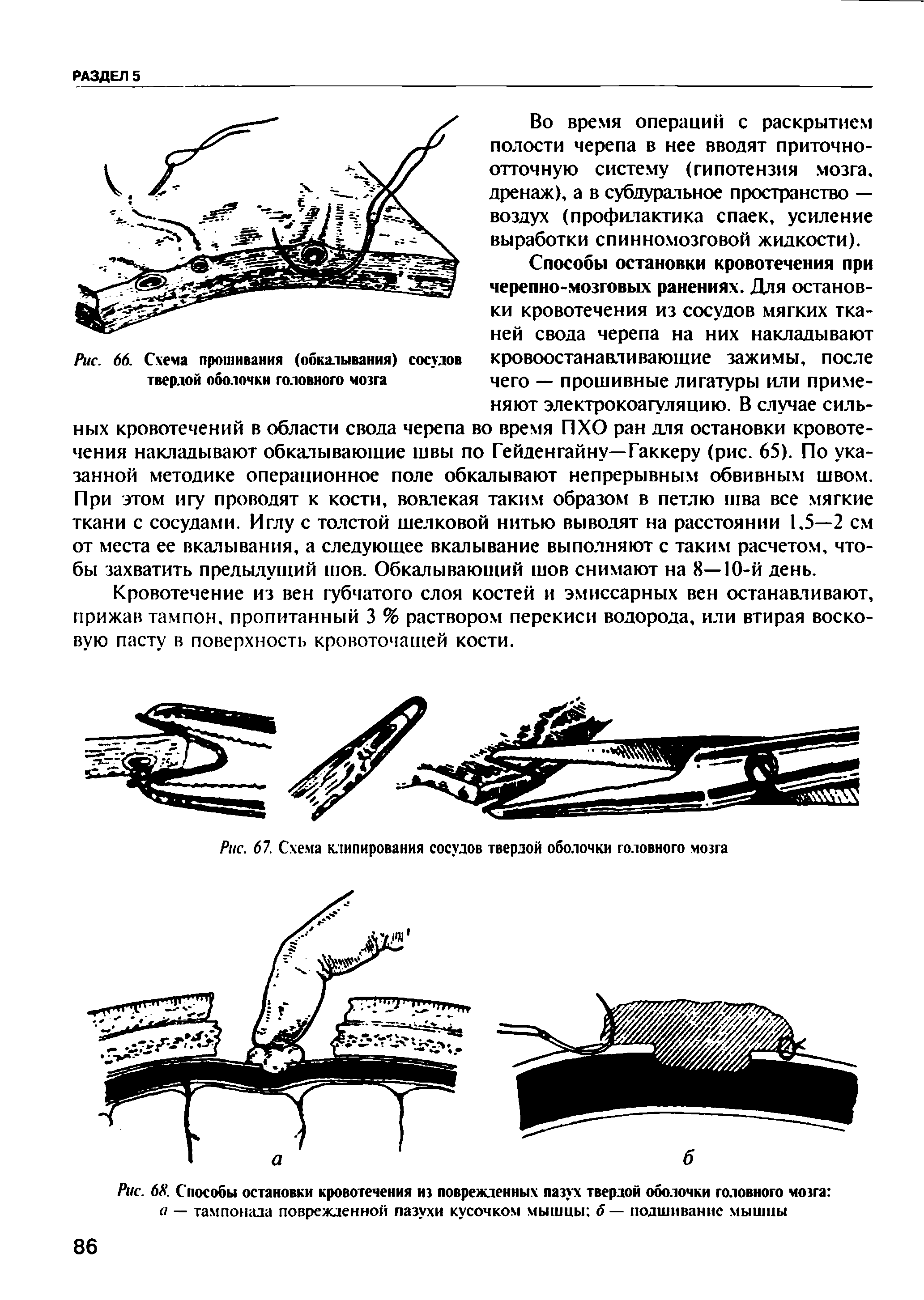 Рис. 68. Способы остановки кровотечения из поврежденных пазух твердой оболочки головного мозга а — тампонада поврежденной пазухи кусочком мышцы б — подшивание мышцы...