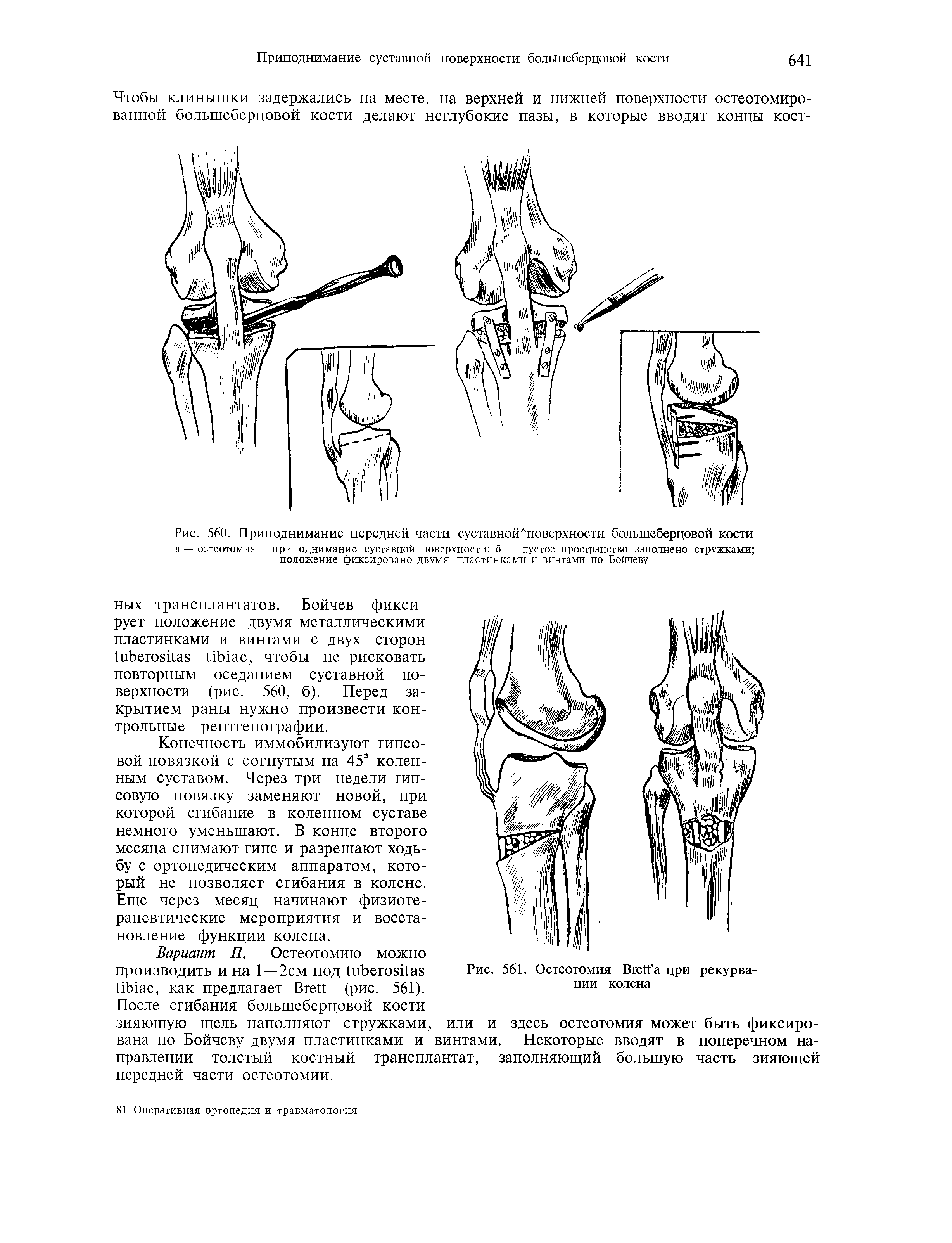 Рис. 560. Приподнимание передней части суставнойЛповерхности большеберцовой кости а — остеотомия и приподнимание суставной поверхности б — пустое пространство заполнено стружками положение фиксировано двумя пластинками и винтами по Бойчеву...