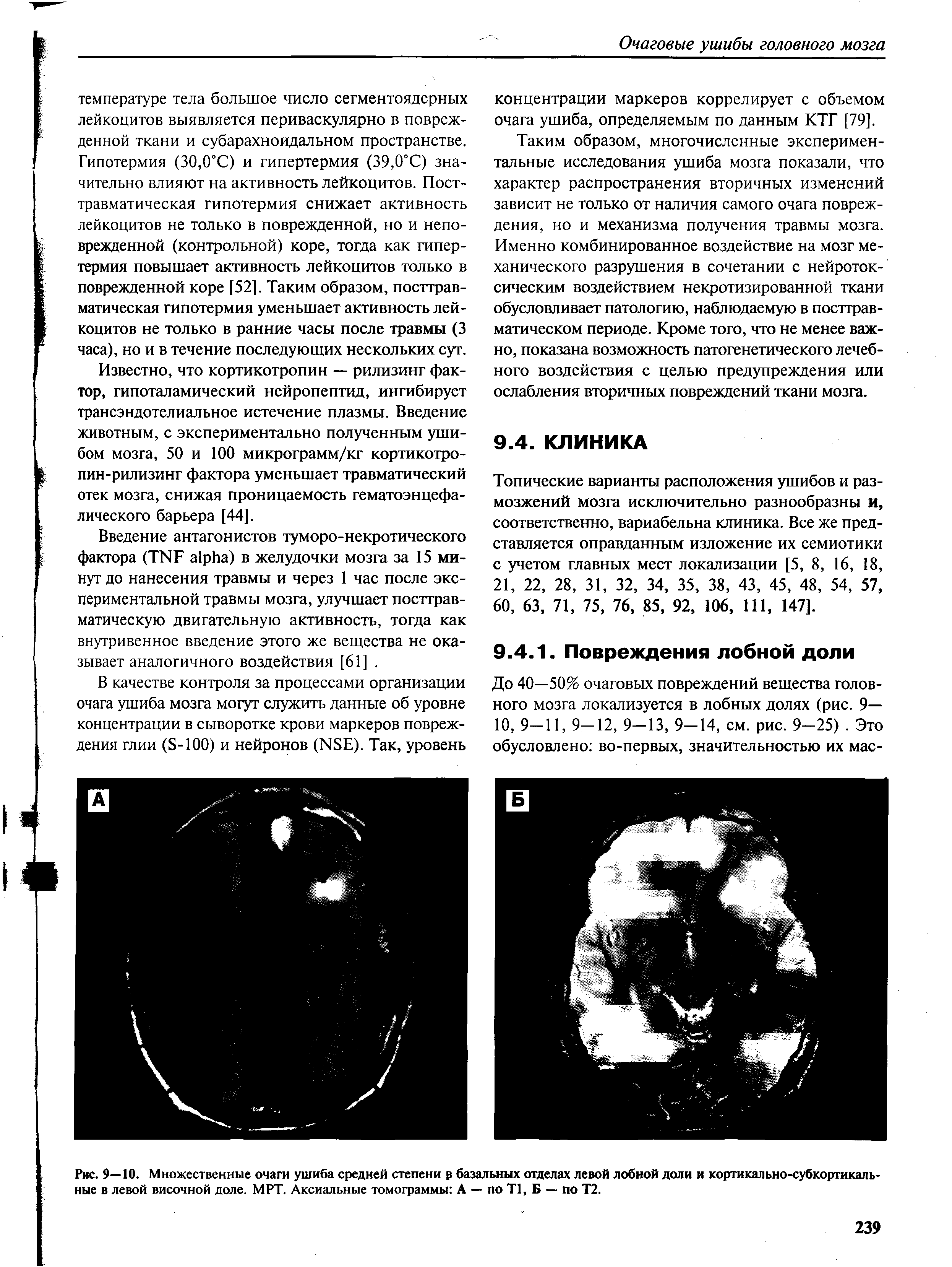 Рис. 9—10. Множественные очаги ушиба средней степени базальных отделах левой лобной доли и кортикально-субкортикальные в левой височной доле. МРТ. Аксиальные томограммы А — по Т1, Б — по Т2.