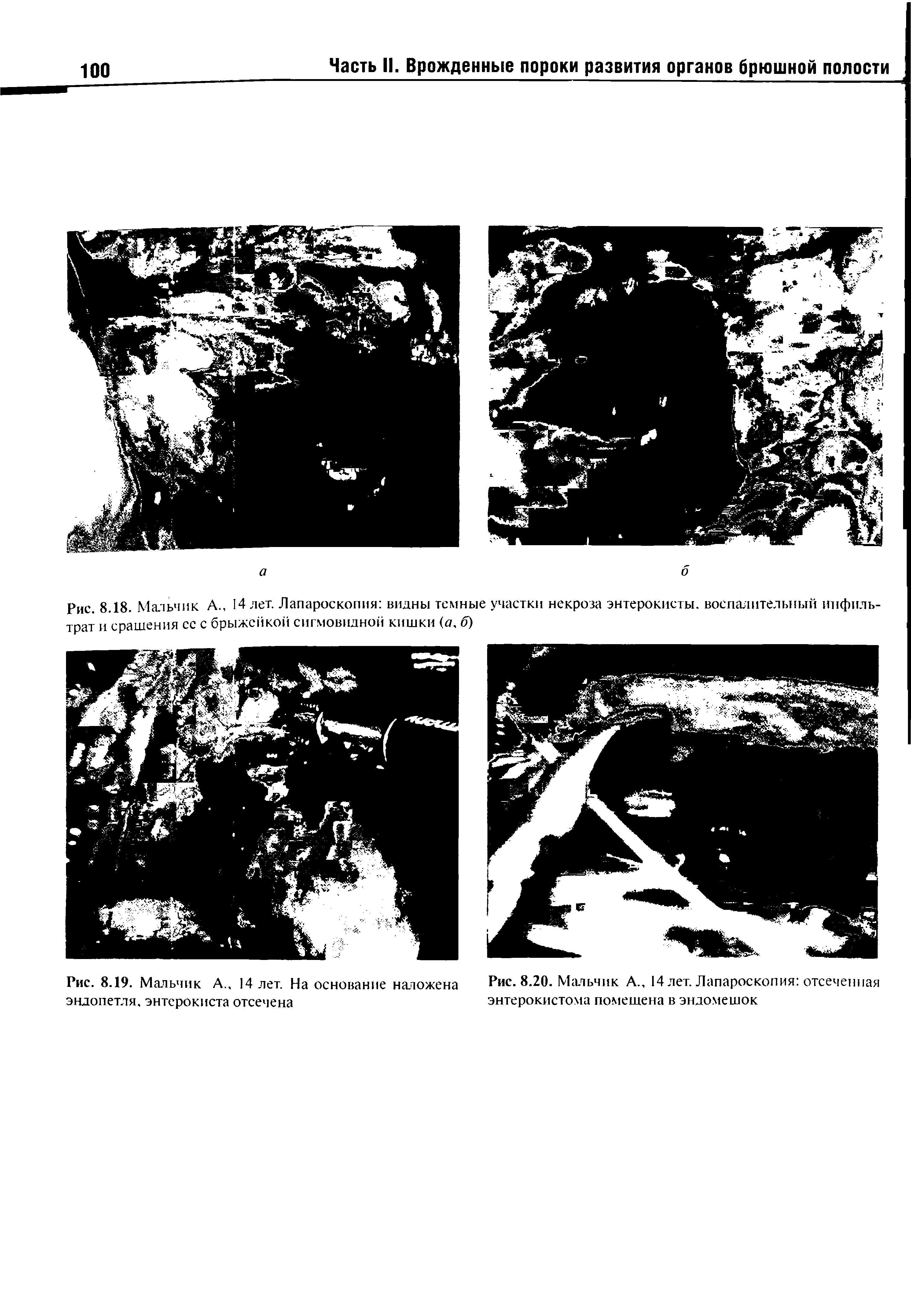 Рис. 8.19. Мальчик А.. 14 лет. На основание наложена Рис. 8.20. Мальчик А., 14 лет. Лапароскопия отсеченная эндопетля, энтсрокиста отсечена энтерокистома помешена в эндомешок...