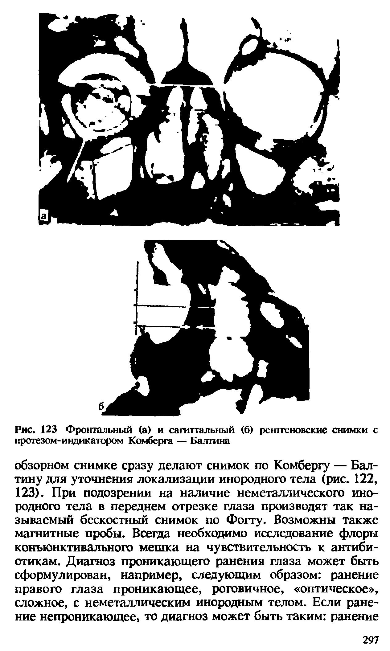 Рис. 123 Фронтальный (а) и сагиттальный (6) рентгеновские снимки с протезом-индикатором Комберга — Балтина...