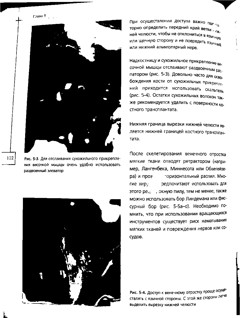 Рис. 5-4. Доступ к венечному отростку проще осуЩв ствлять с язычной стороны. С этой же стороны легче выделить вырезку нижней челюсти...