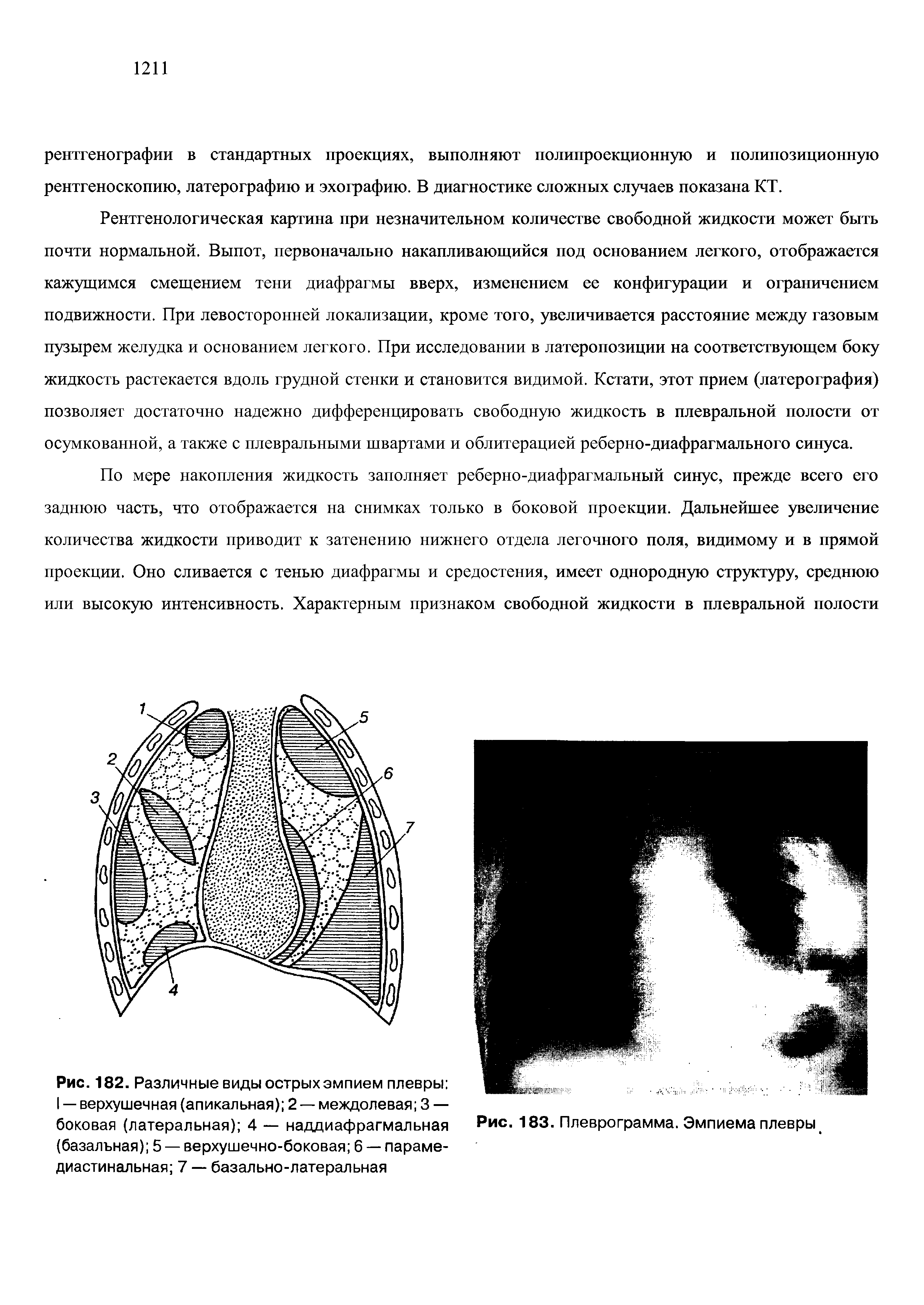Рис. 182. Различные виды острых эмпием плевры I — верхушечная (апикальная) 2 — междолевая 3 — боковая (латеральная) 4 — наддиафрагмальная (базальная) 5 — верхушечно-боковая 6 — параме-диастинальная 7 — базально-латеральная...