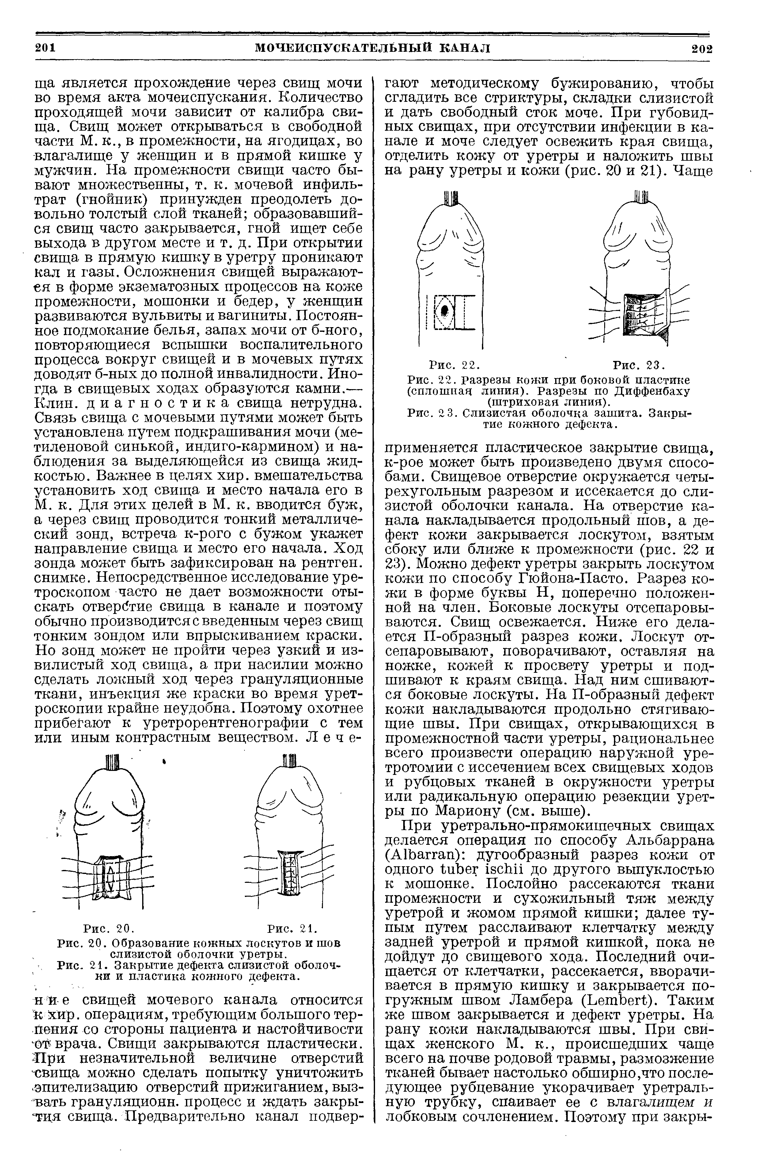 Рис. 20. Образование кожных лоскутов и шов слизистой оболочки уретры.