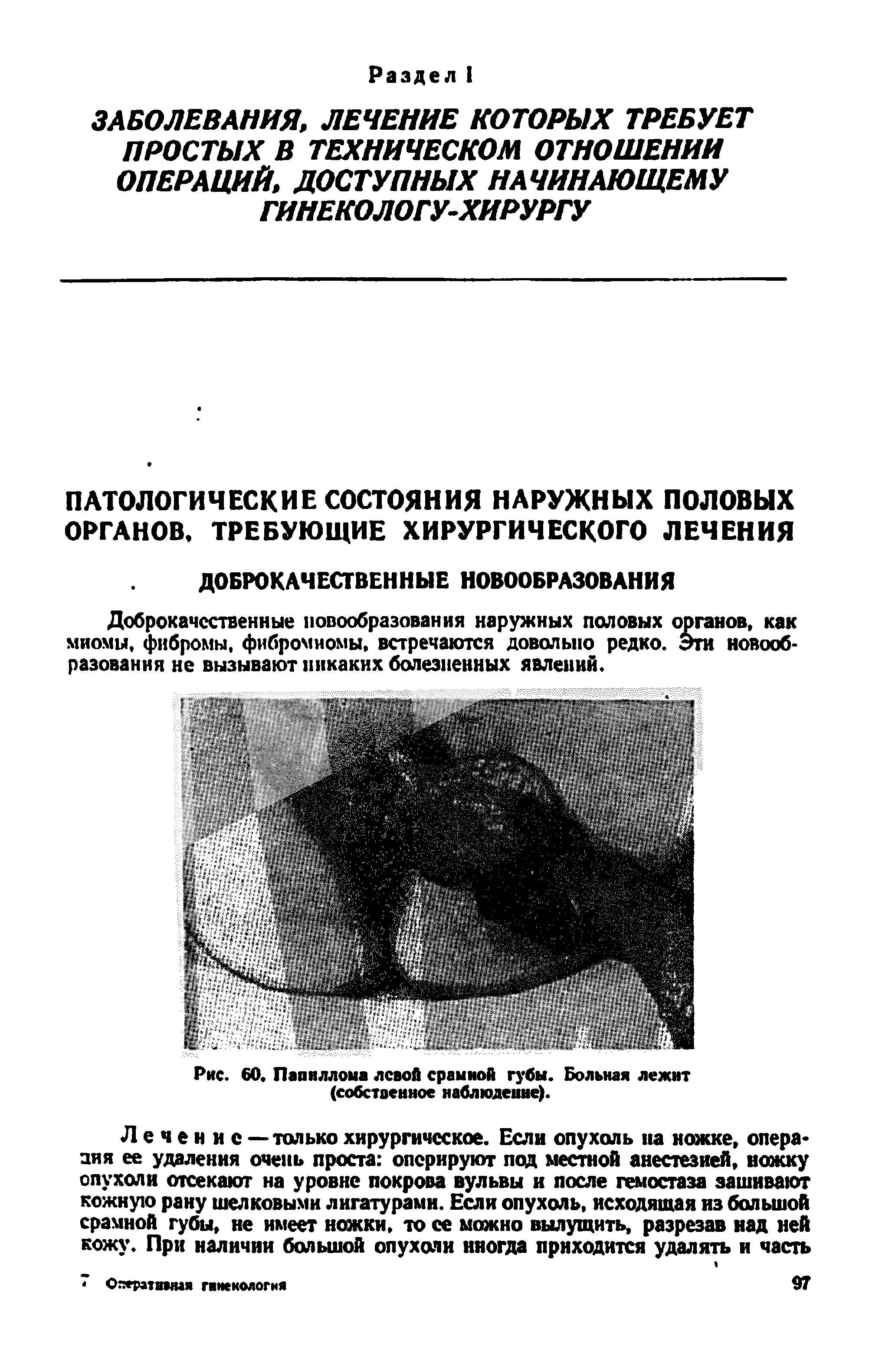 Рис. 60. Папиллома левой срамной губы. Больная лежит (собственное наблюдение).