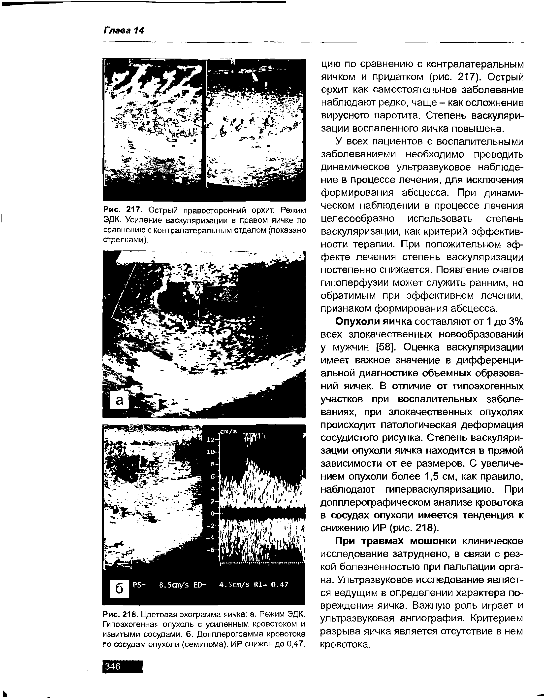 Рис. 218. Цветовая эхограмма яичка а. Режим ЭДК. Гипоэхогенная опухоль с усиленным кровотоком и извитыми сосудами. 6. Допплерограмма кровотока по сосудам опухоли (семинома). ИР снижен до 0,47.