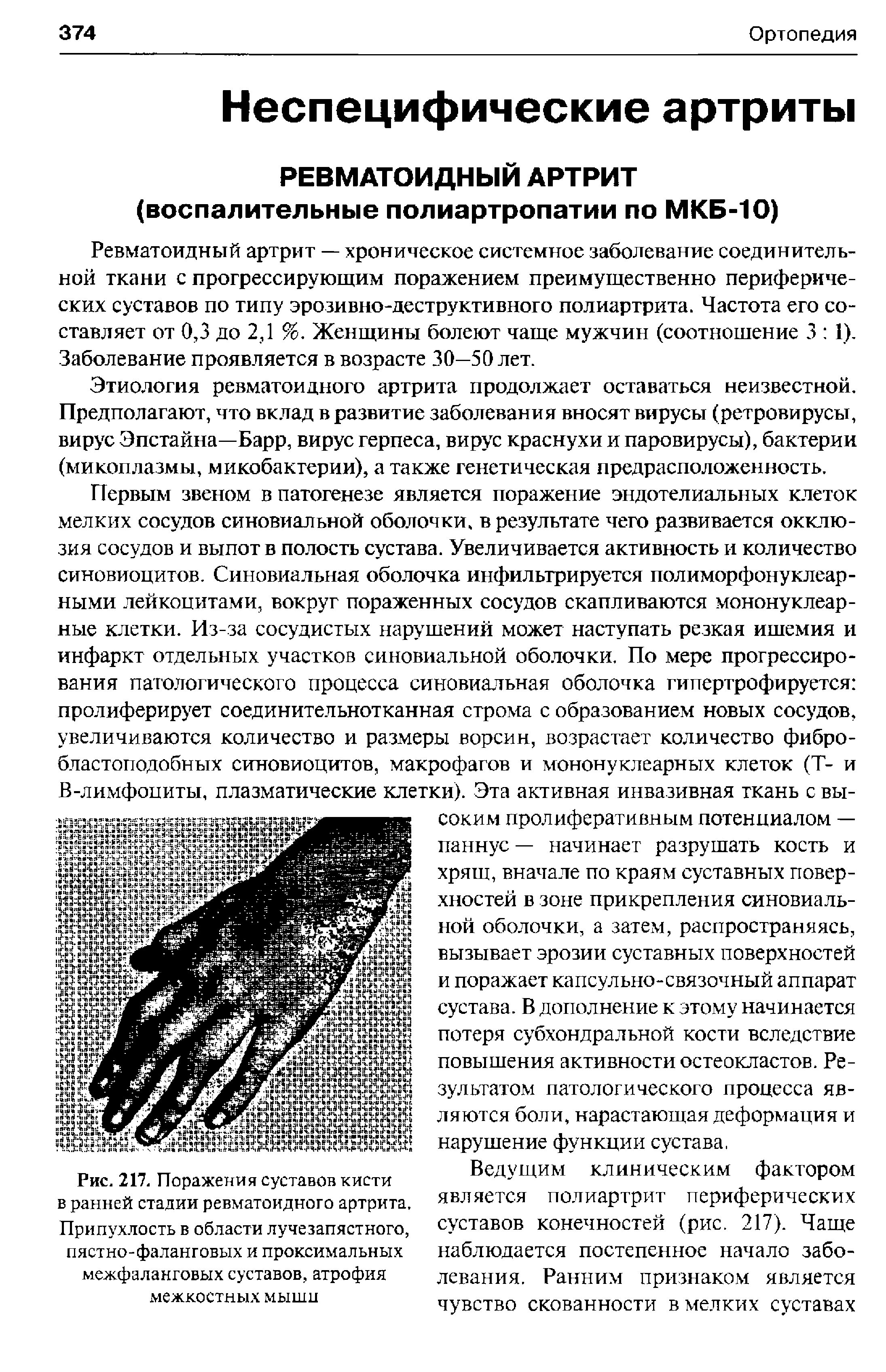 Рис. 217. Поражения суставов кисти в ранней стадии ревматоидного артрита. Припухлость в области лучезапястного, пястно-фаланговых и проксимальных межфаланговых суставов, атрофия межкостных мыши...