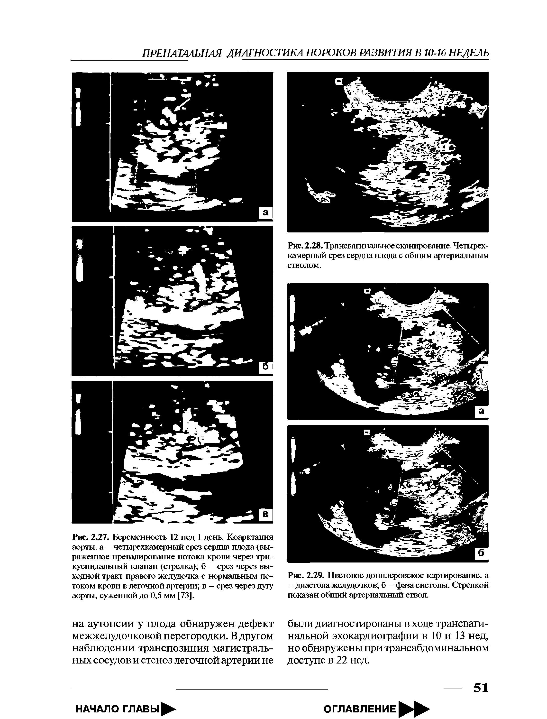 Рис. 2.27. Беременность 12 нед 1 день. Коарктация аорты, а четырехкамерный срез сердца плода (выраженное превалирование потока крови через трикуспидальный клапан (стрелка) б - срез через выходной тракт правого желудочка с нормальным потоком крови в легочной артерии в - срез через дугу аорты, суженной до 0,5 мм [73].