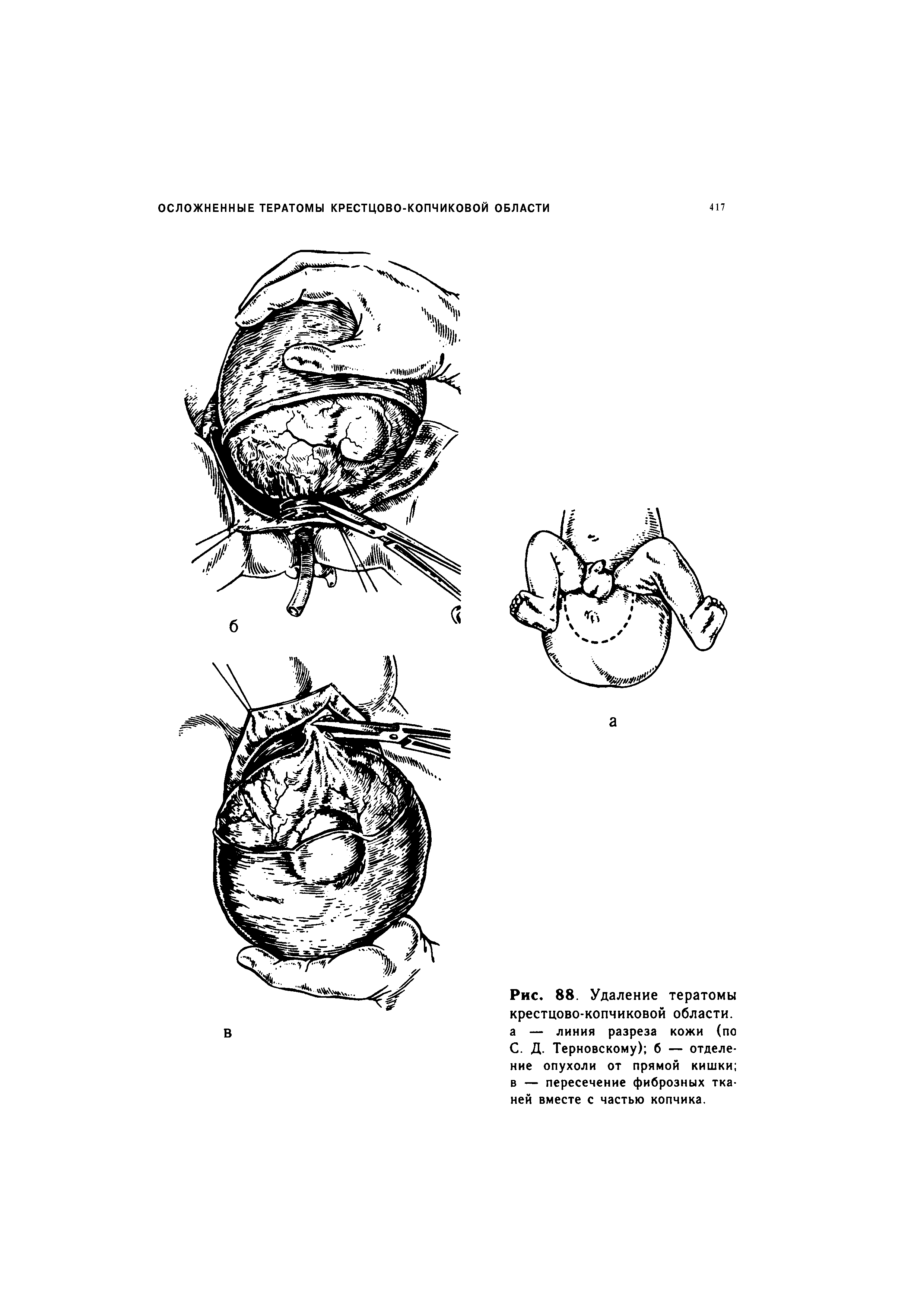 Рис. 88. Удаление тератомы крестцово-копчиковой области, а — линия разреза кожи (по С. Д. Терновскому) б — отделение опухоли от прямой кишки в — пересечение фиброзных тканей вместе с частью копчика.