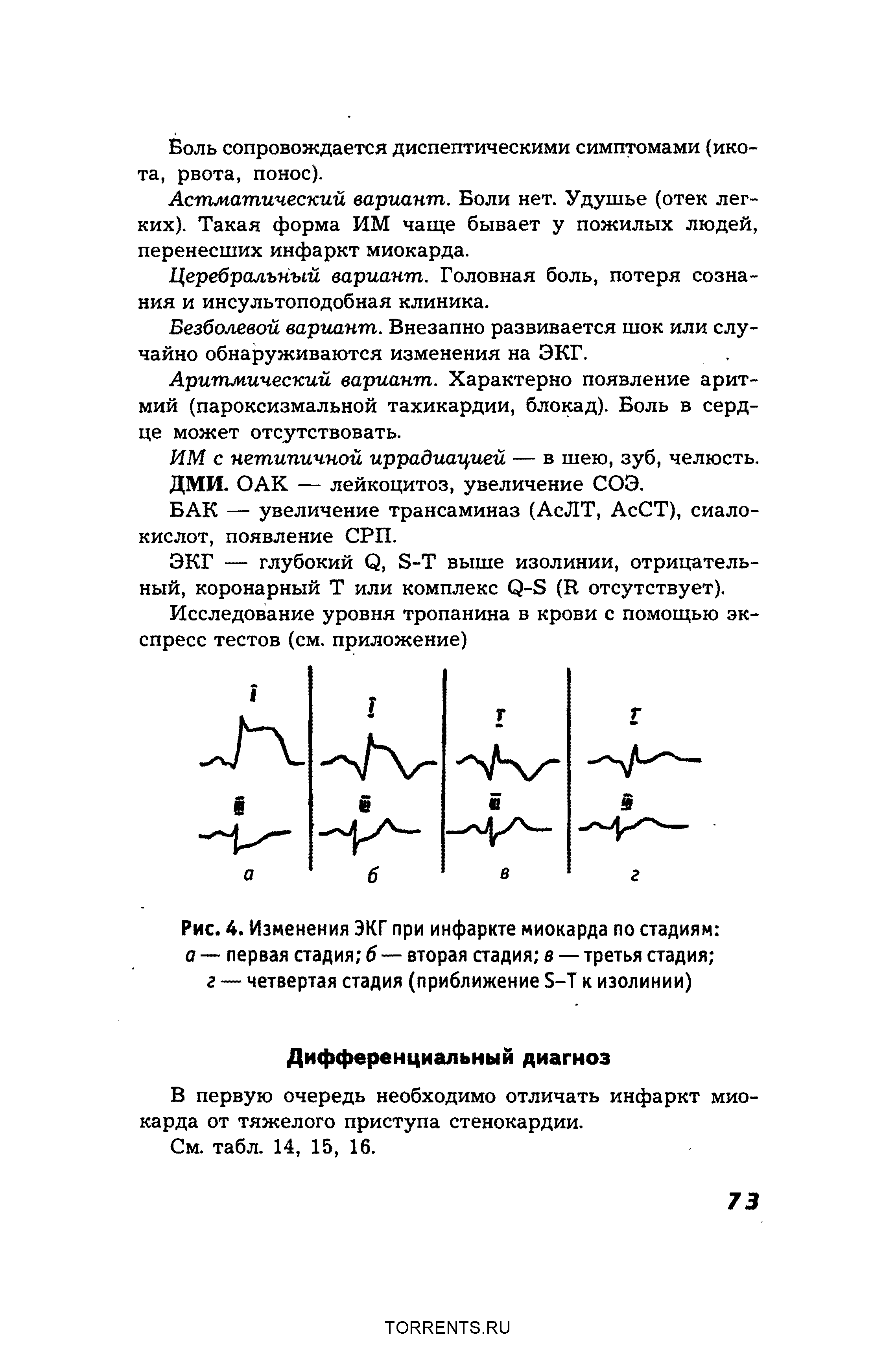 Рис. 4. Изменения ЭКГ при инфаркте миокарда по стадиям а — первая стадия б — вторая стадия в — третья стадия ...