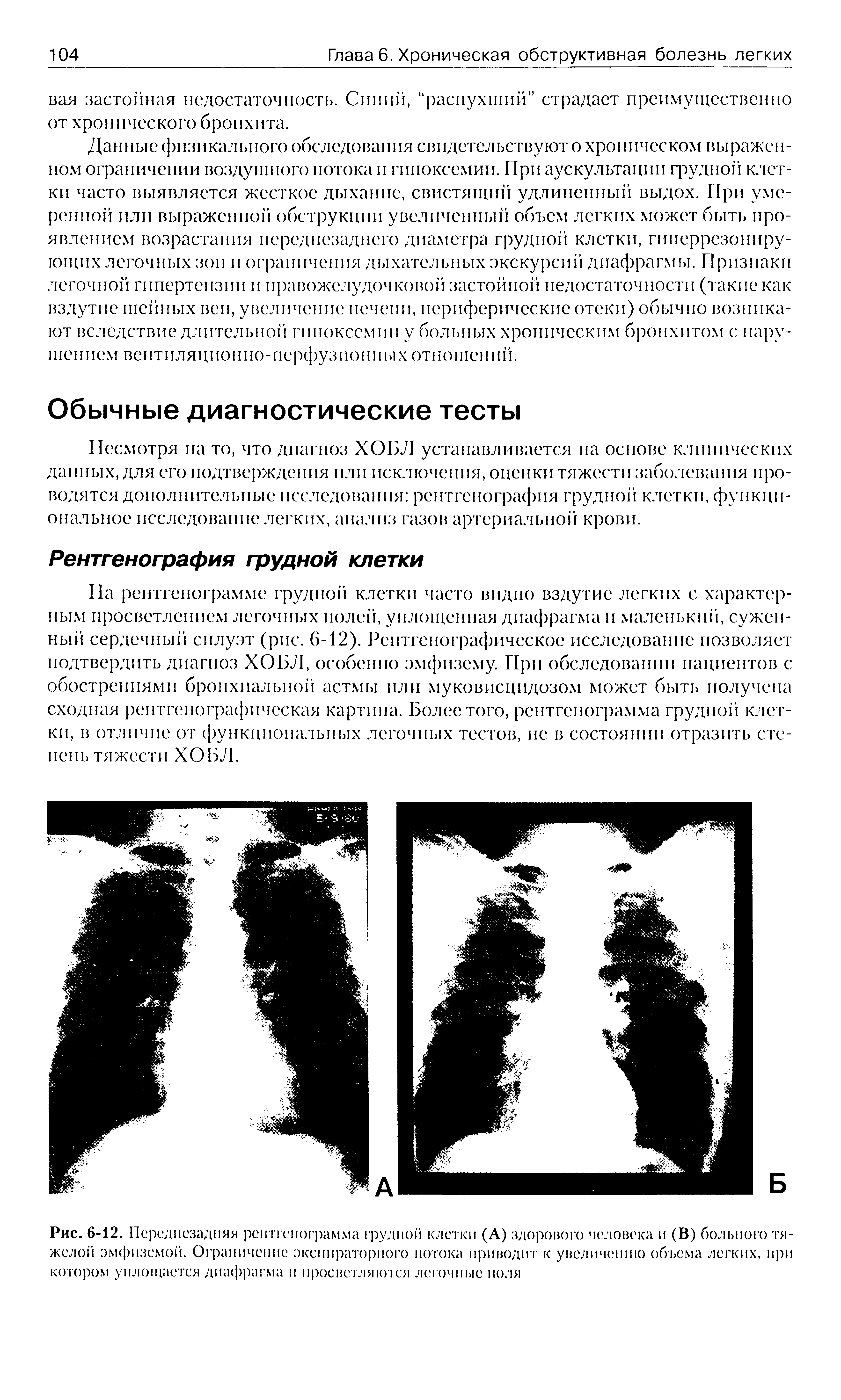 Рис. 6-12. Переднезадняя рентгенограмма грудной клетки (А) здорового человека и (В) больного тяжелой эмфиземой. Ограничение экспираторного потока приводит к увеличению объема легких, при котором уплощается диафрагма п просветляю ся легочные ноля...