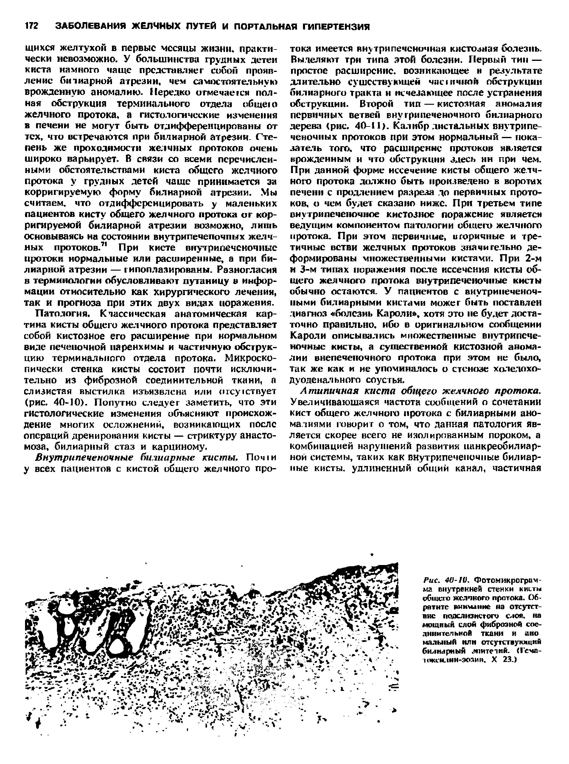 Рис. 40-10. Фотомикрограмма внутренней стенки кисты общего желчного протока. Обратите внимание па отсутствие подслизистого слоя. на мощный слой фиброзной соединительной ткани и ано мяльный или отсутствующий билиарный лпитепнк. (Гема-нжеюшн-эолин. X 23.)...