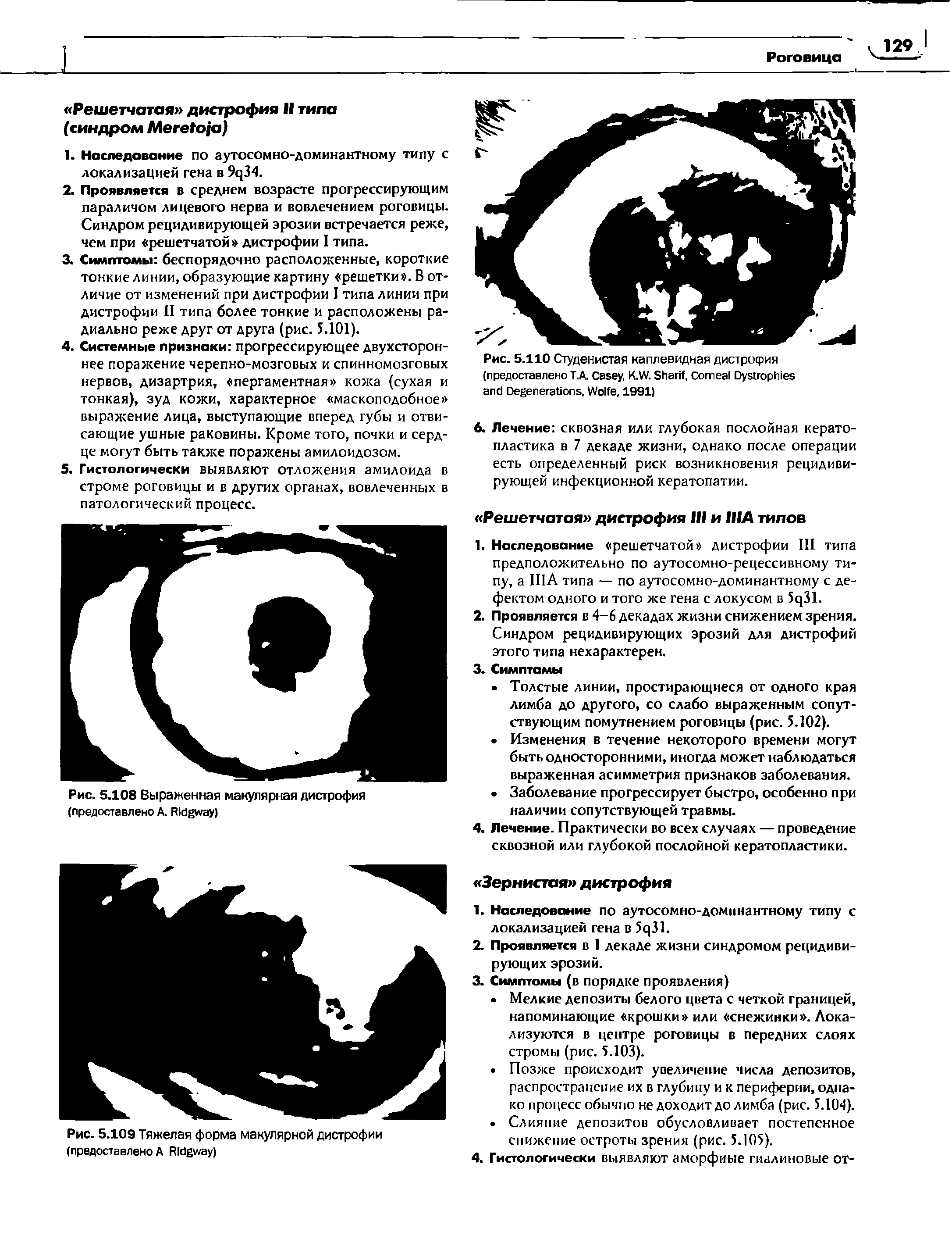 Рис. 5.110 Студенистая каплевидная дистрофия (предоставлено Т.А. C , K.W. S , C D D , W , 1991)...