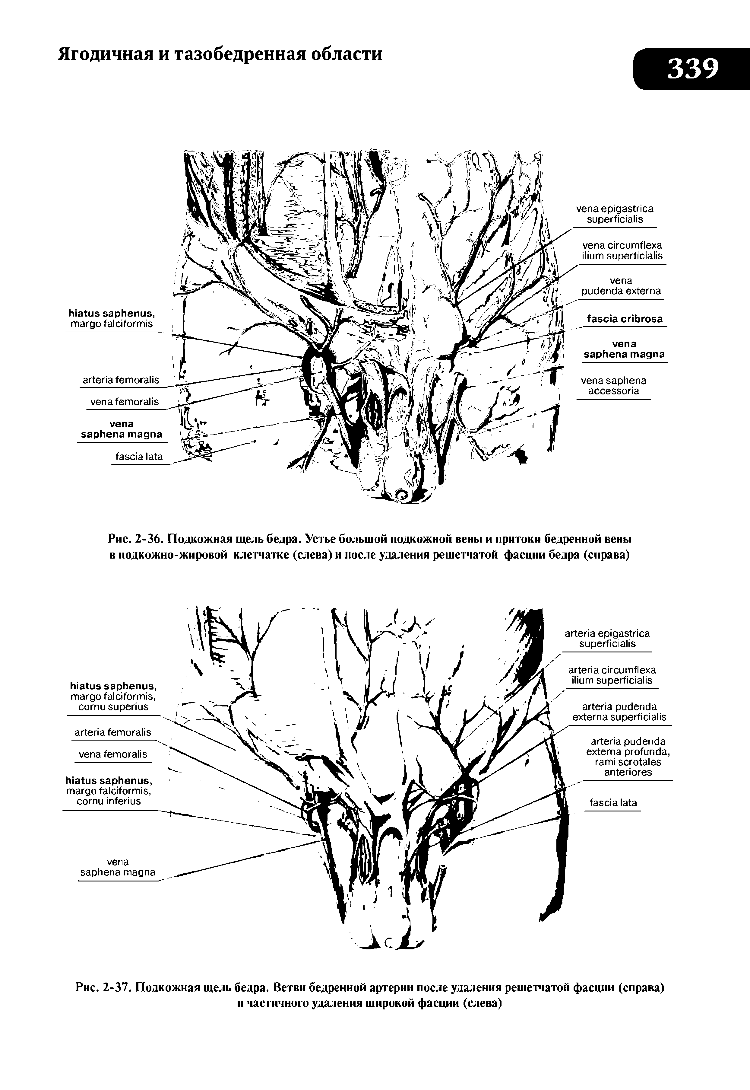 Рис. 2-36. Подкожная щель бедра. Устье большой подкожной вены и притоки бедренной вены в подкожно-жировой клетчатке (слева) и после удаления решетчатой фасции бедра (справа)...