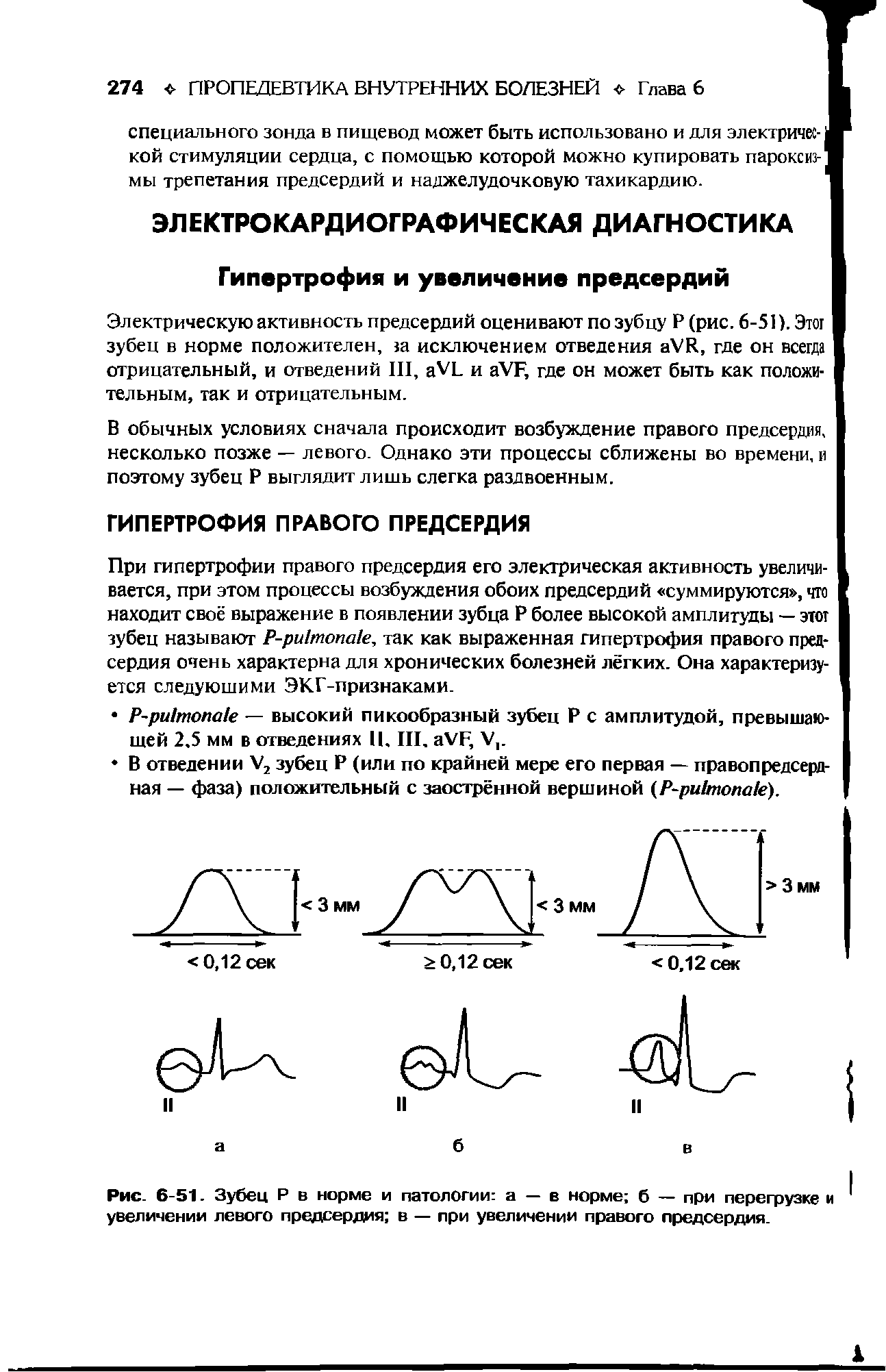 Рис. 6-51. Зубец Р в норме и патологии а — в норме б — при перегрузке увеличении левого предсердия в — при увеличении правого предсердия.