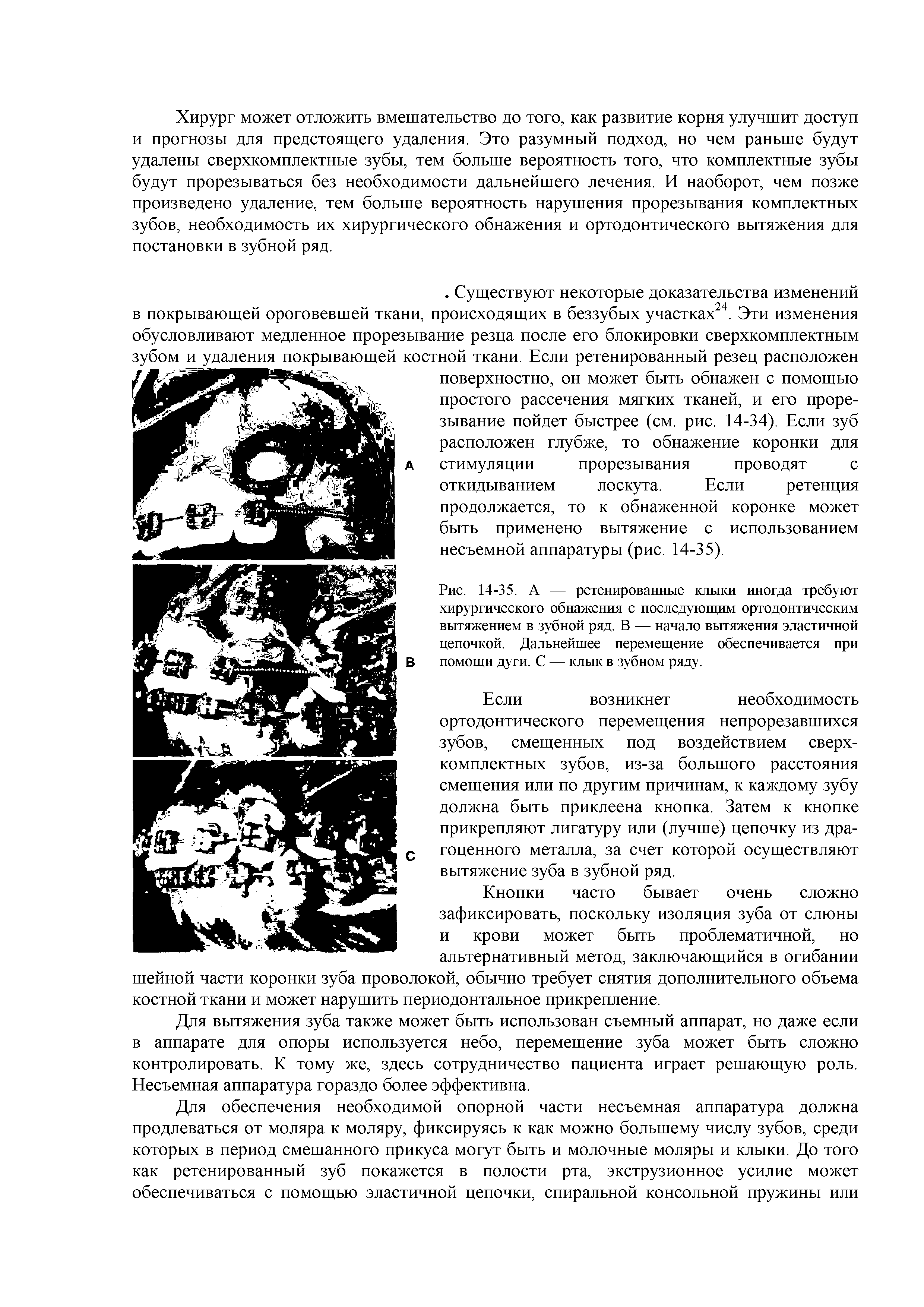 Рис. 14-35. А — ретенированные клыки иногда требуют хирургического обнажения с последующим ортодонтическим вытяжением в зубной ряд. В — начало вытяжения эластичной цепочкой. Дальнейшее перемещение обеспечивается при помощи дуги. С — клык в зубном ряду.