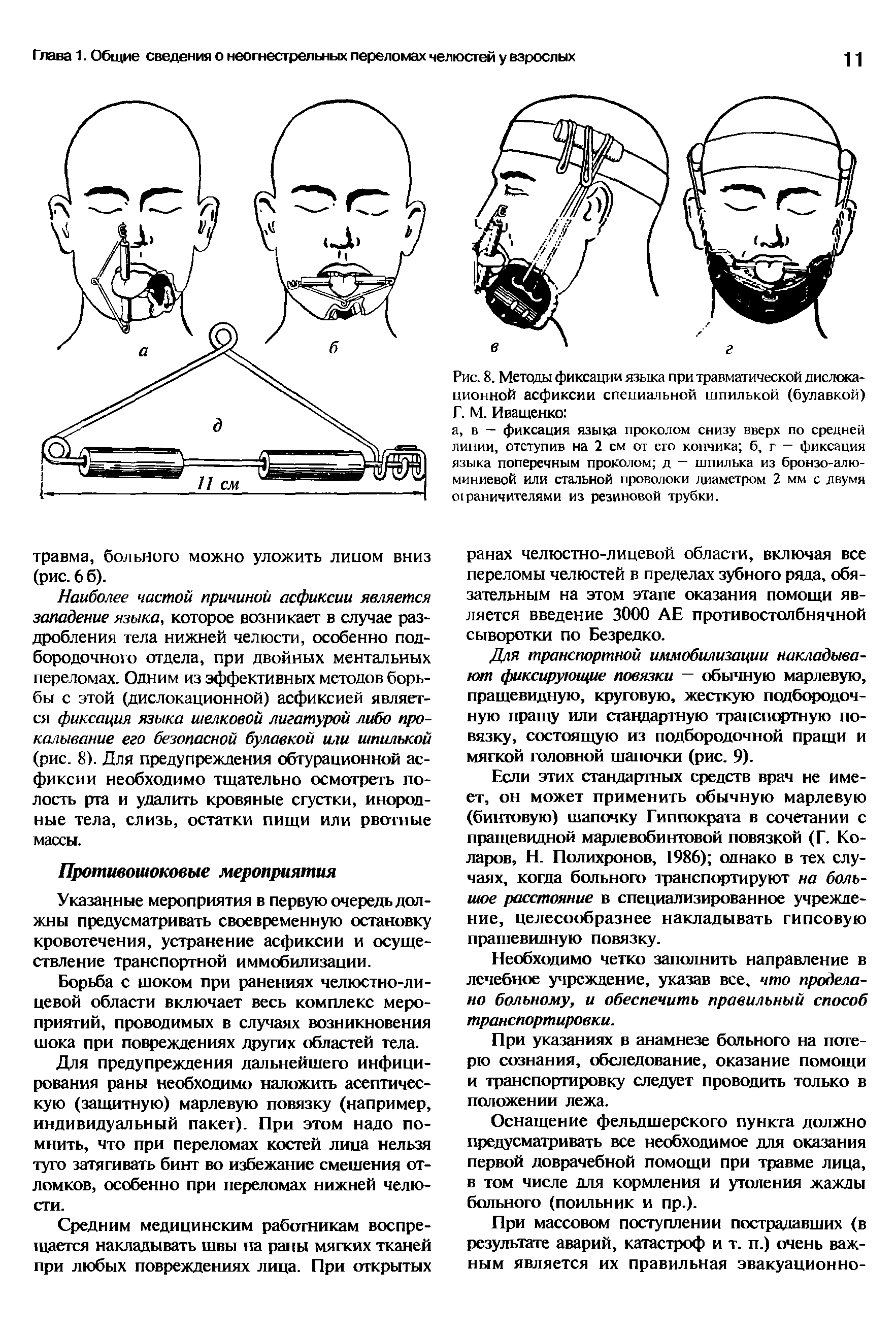 Рис. 8. Методы фиксации языка при травматической дислокационной асфиксии специальной шпилькой (булавкой) Г. М. Иващенко ...