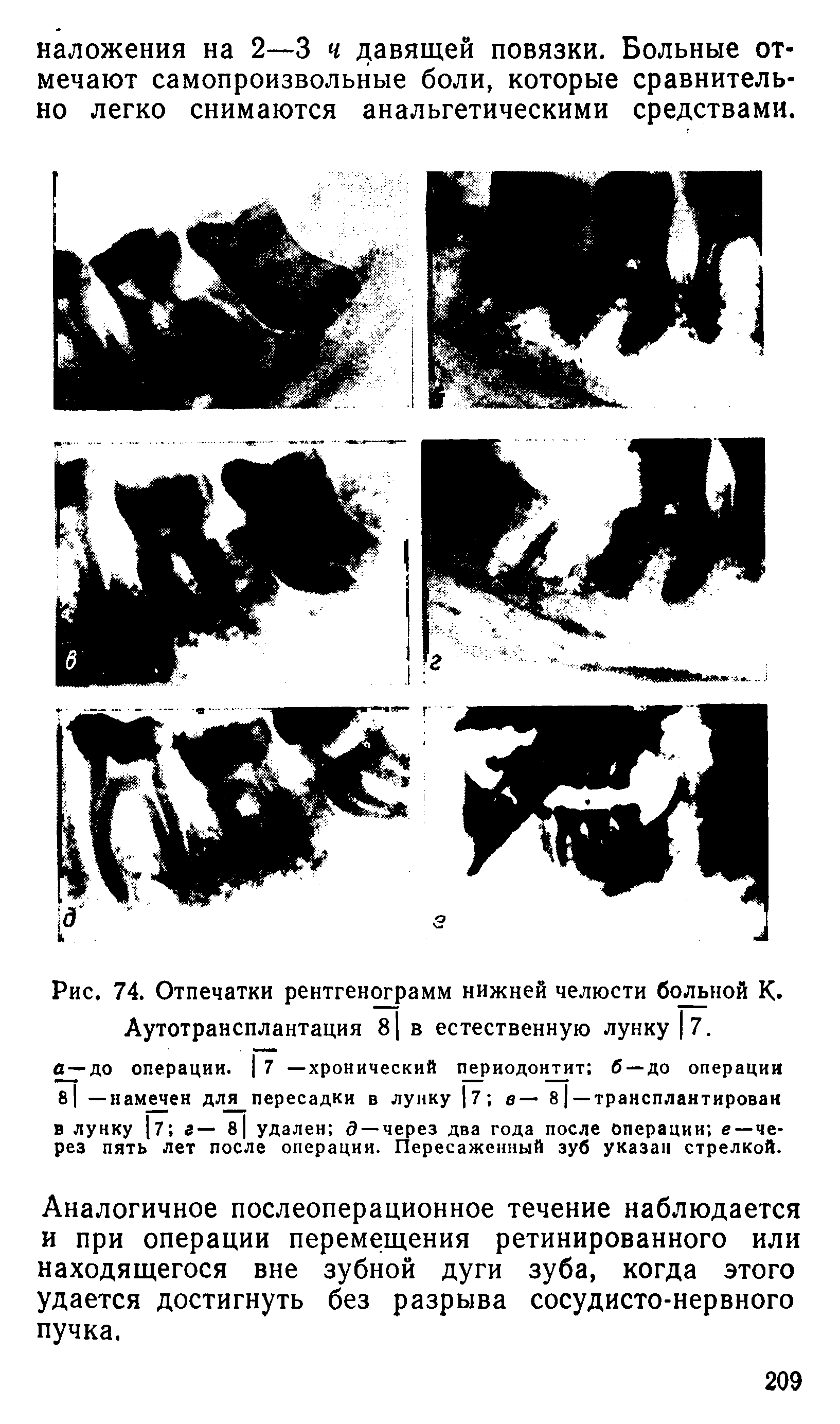 Рис. 74. Отпечатки рентгенограмм нижней челюсти больной К. Аутотрансплантация 8 в естественную лунку 7.